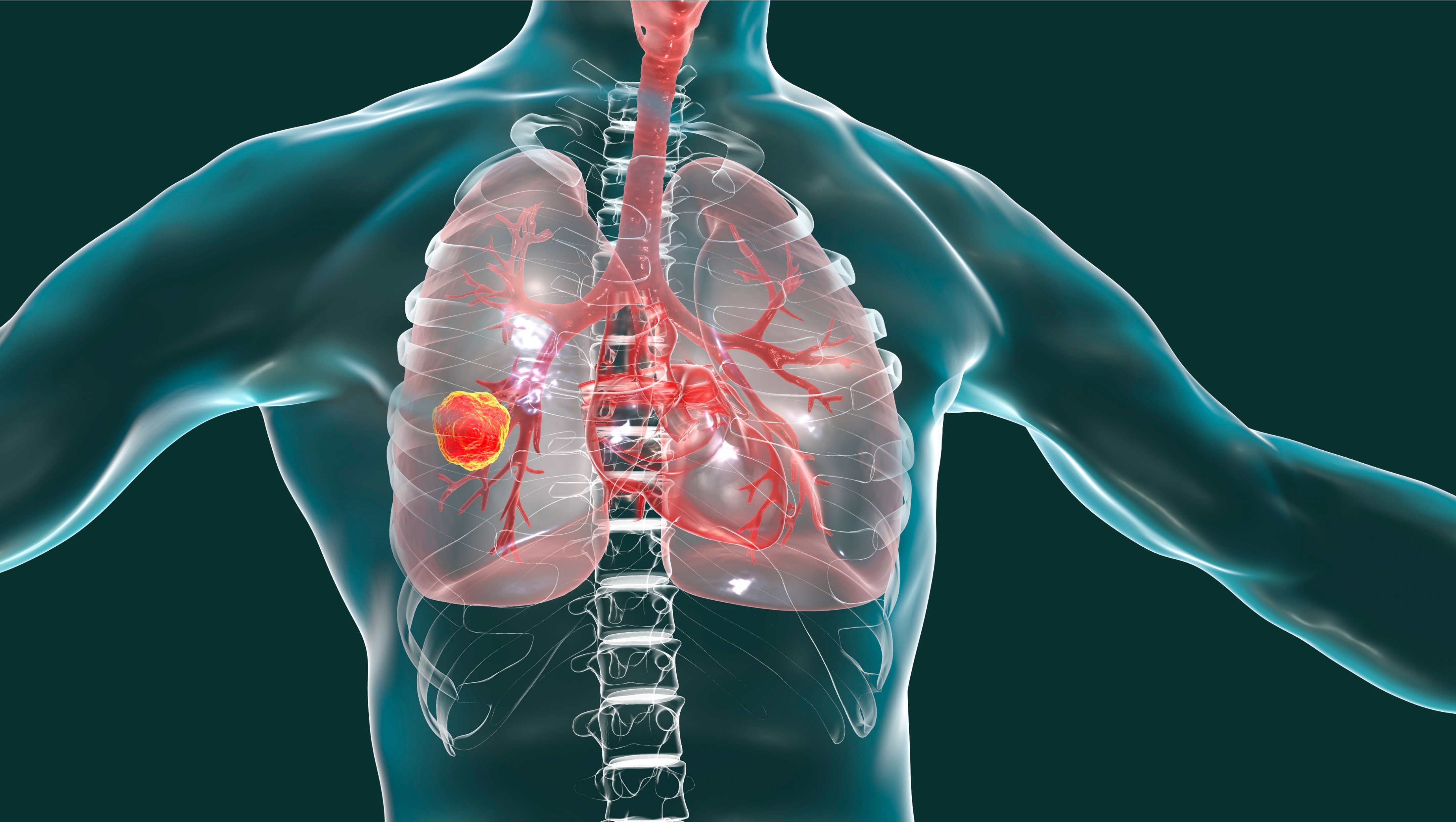 CPCNP metastásico: FDA aprueba zongertinib para pacientes con mutaciones activadoras de HER2