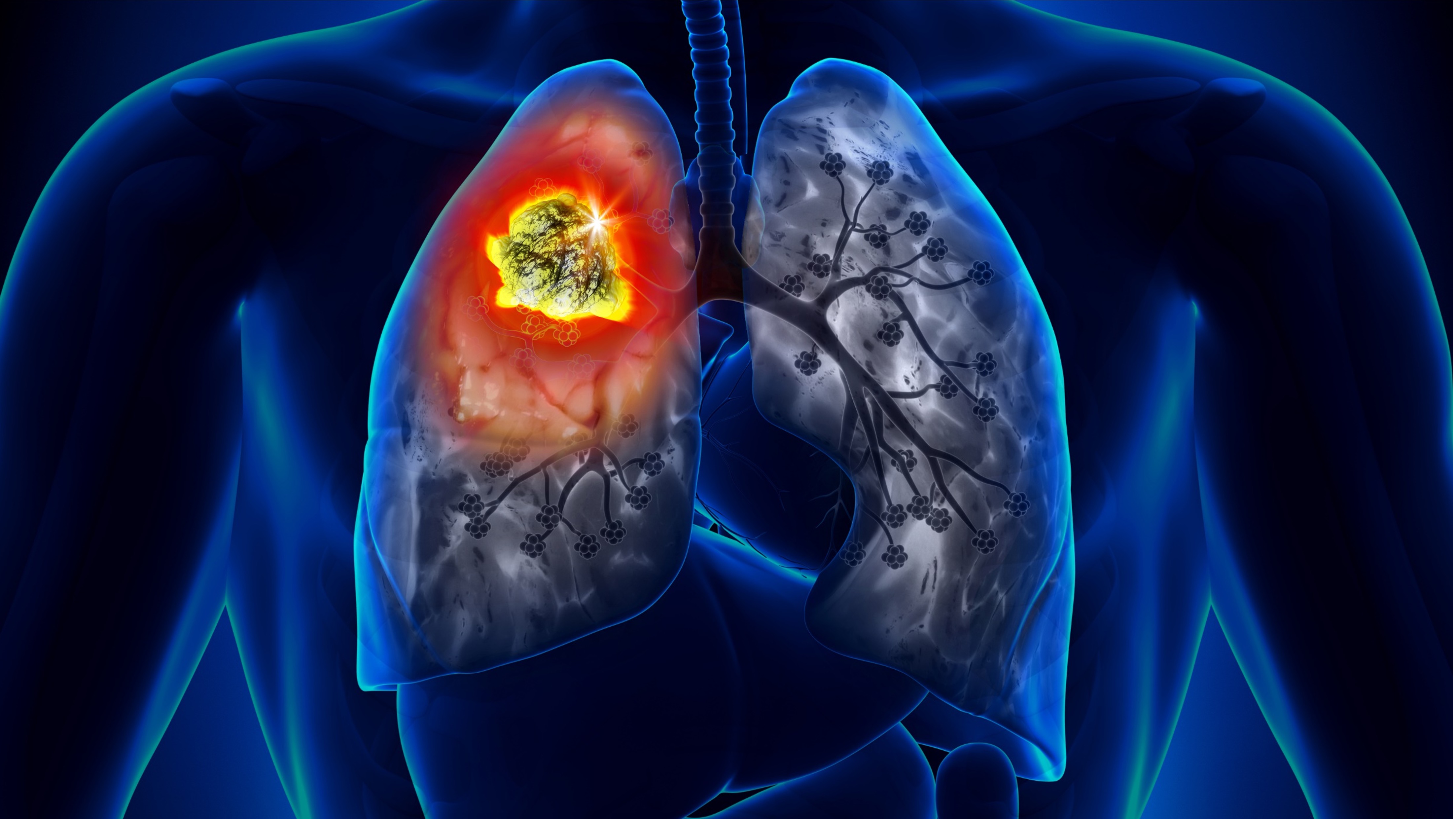 CPCNP metastásico: beneficio a 4 años con sugemalimab, estudio GEMSTONE-302 