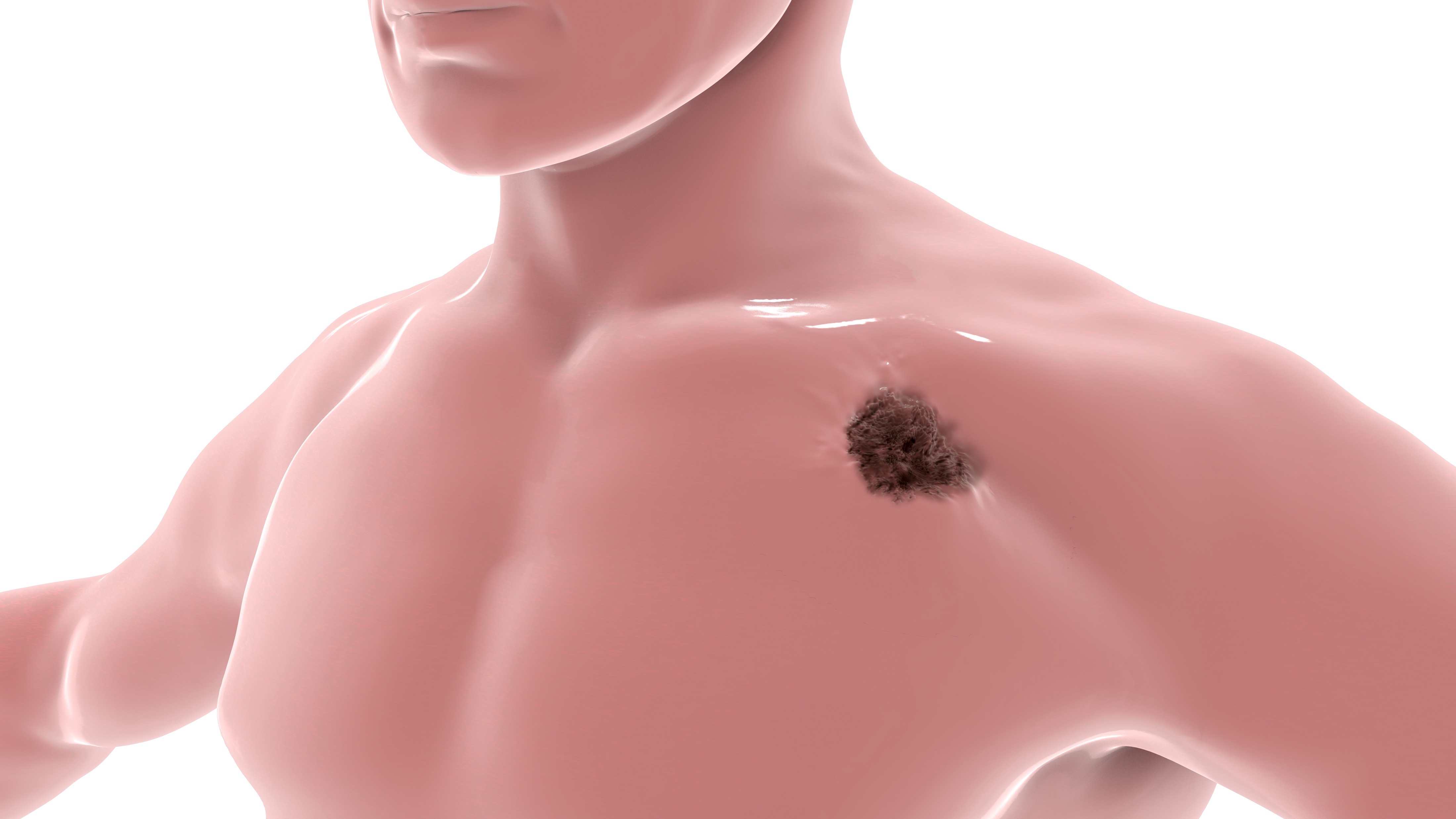Melanoma avanzado: vacuna inmunomoduladora y pembrolizumab muestran tendencia positiva en SLP, estudio IOB-013/KN-D18