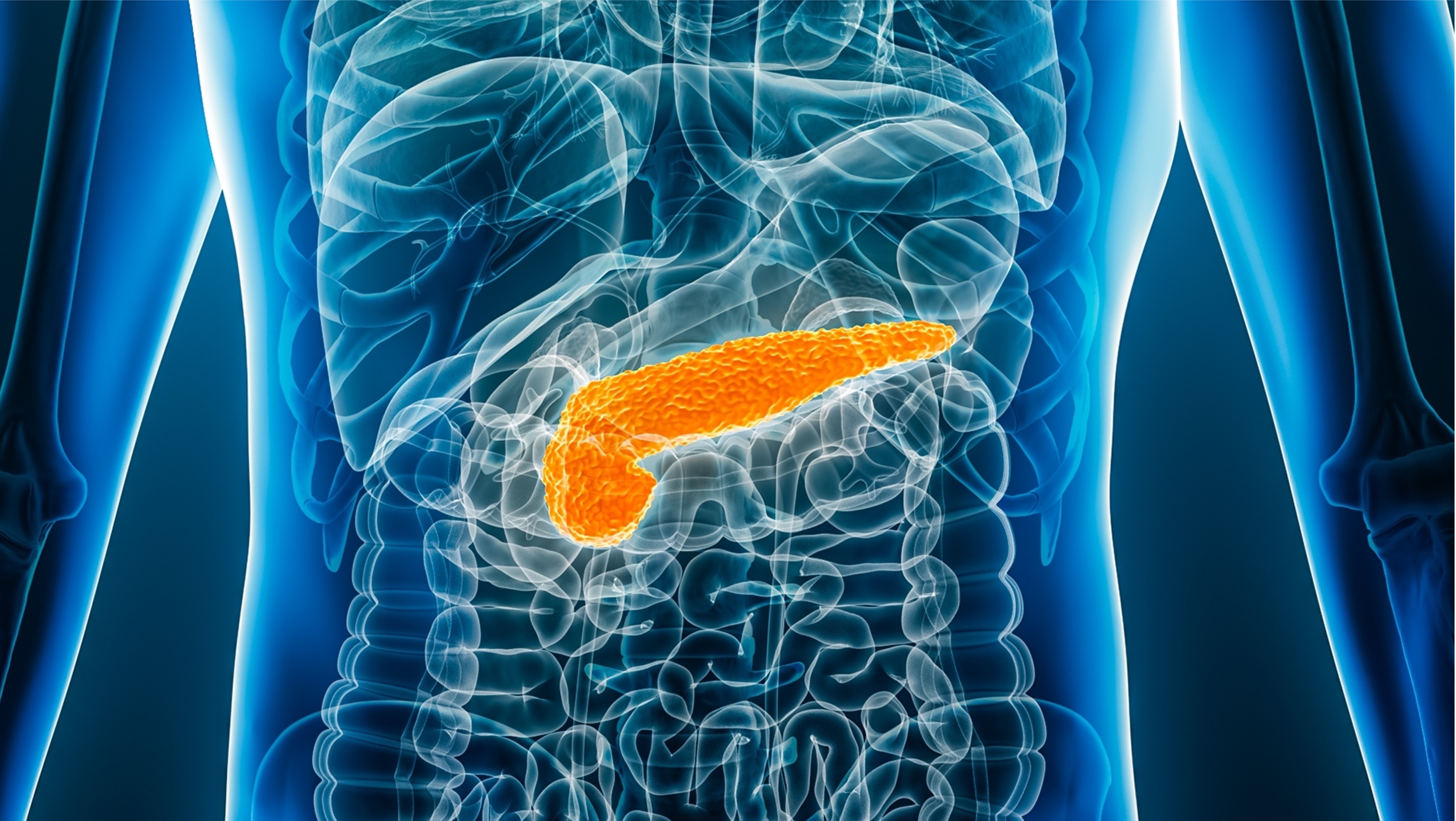 Cáncer de páncreas avanzado: utidelona recibe designación huérfana de la FDA