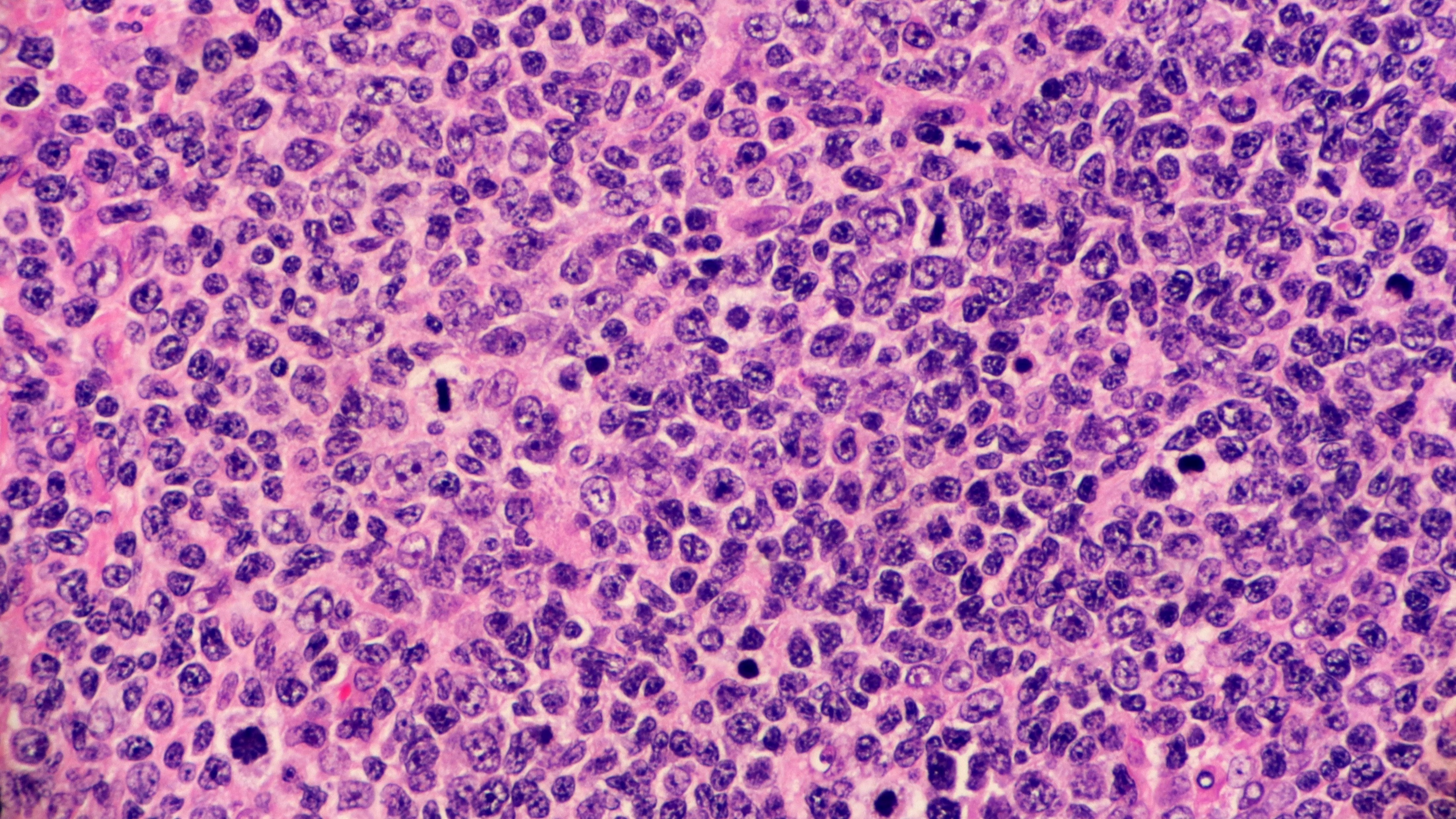 LDCBG R/R no elegible para trasplante: mosunetuzumab + polatuzumab vedotin mejoran la SLP y las tasas de respuesta, estudio SUNMO