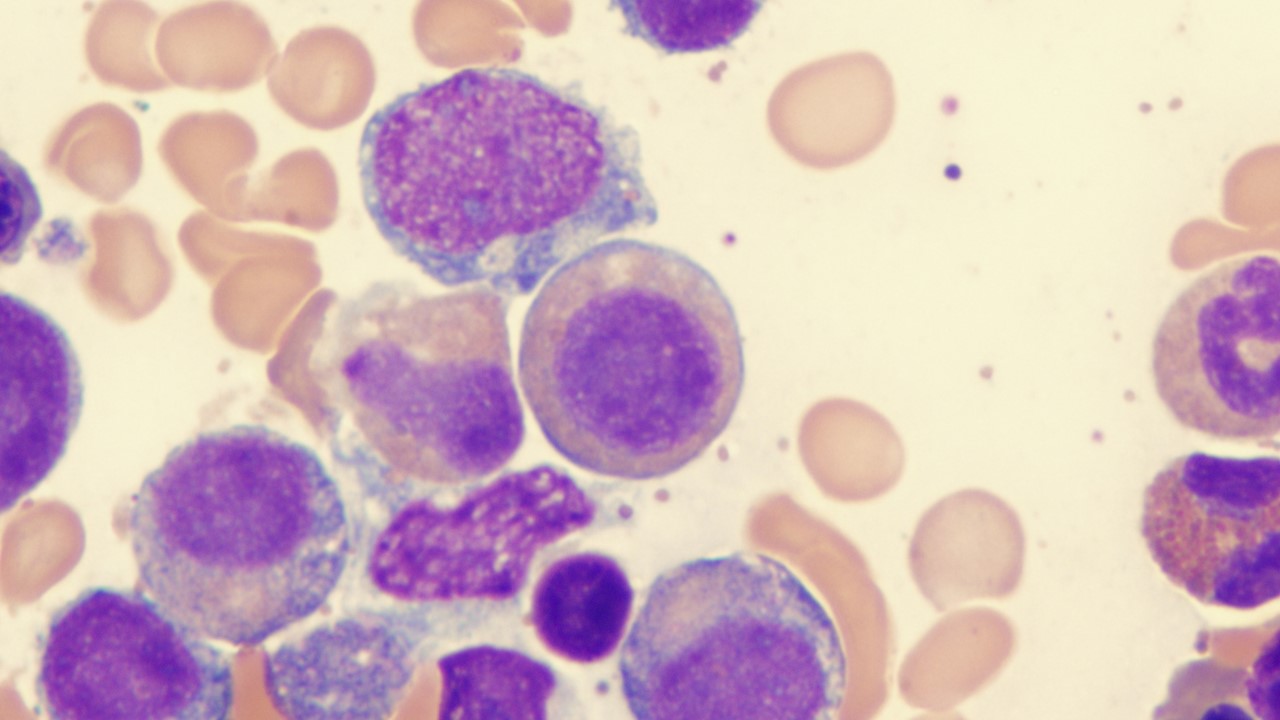 SMD de riesgo intermedio y alto: venetoclax más azacitidina no mejora la SG, estudio VERONA
