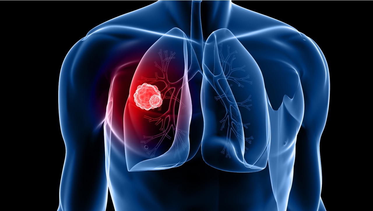 Adenocarcinoma pulmonar GGO-dominante: omisión segura de la disección mediastinal de ganglios linfáticos, estudio ECTOP-1009