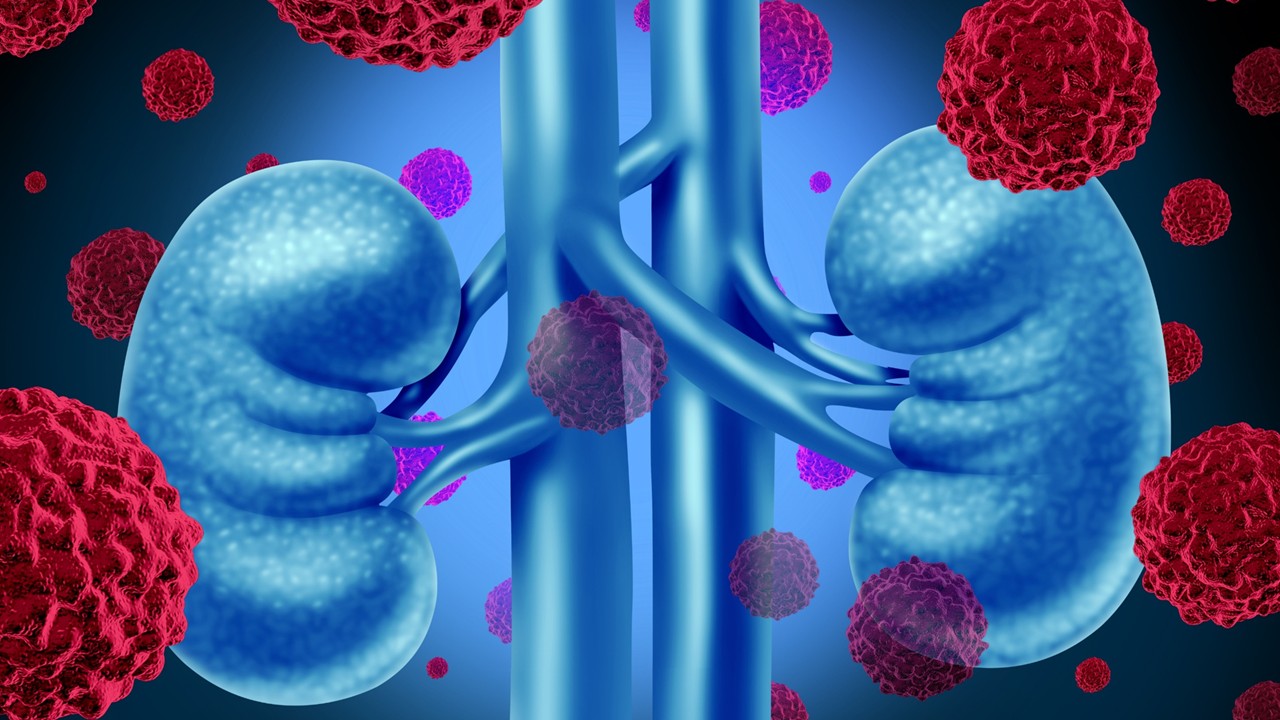 Carcinoma renal de células claras tras nefrectomía: la combinación de pembrolizumab y belzutifan mejora la SLE, estudio LITESPARK-022