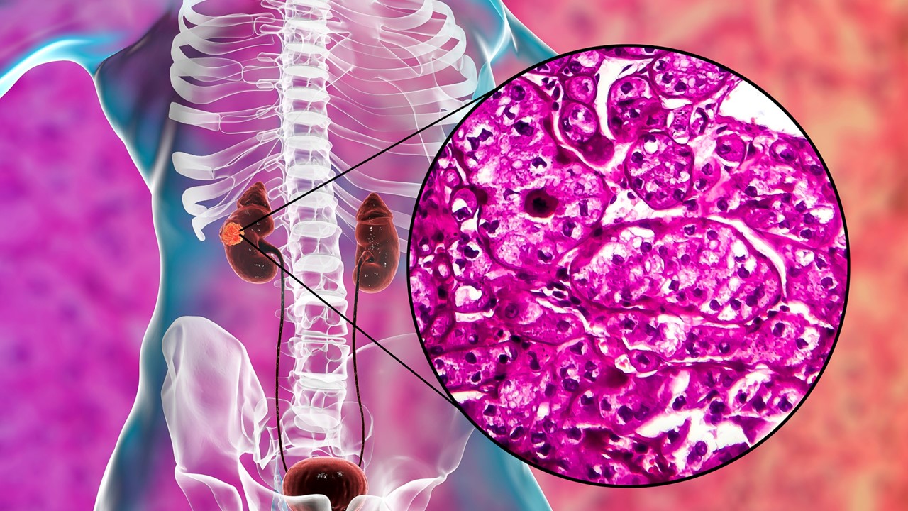 Carcinoma renal de células claras avanzado: belzutifan más lenvatinib mejora la SLP en pacientes con progresión tras inmunoterapia, estudio LITESPARK-011