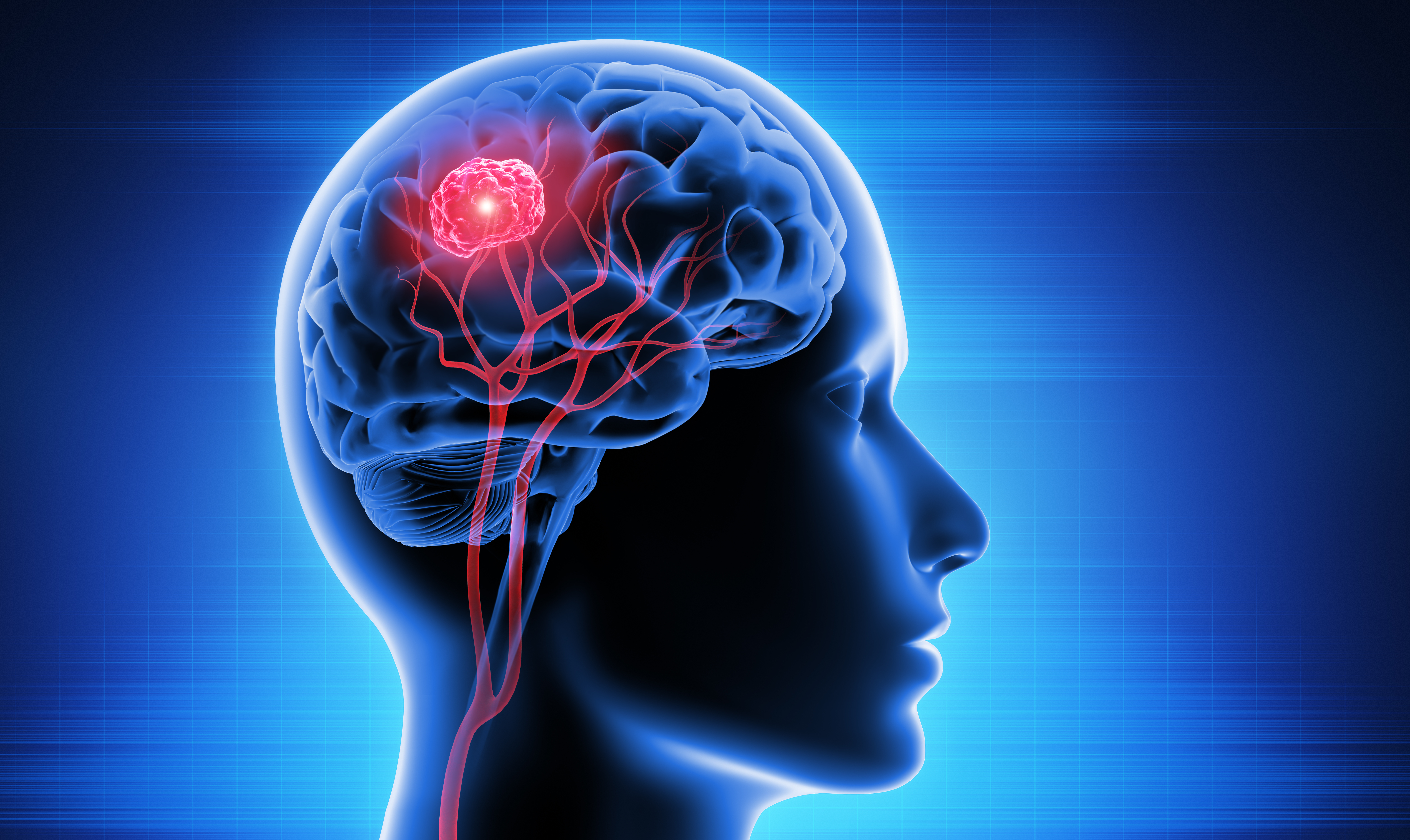Glioblastoma: cintredekin besudotox obtiene designación de medicamento huérfano por la FDA