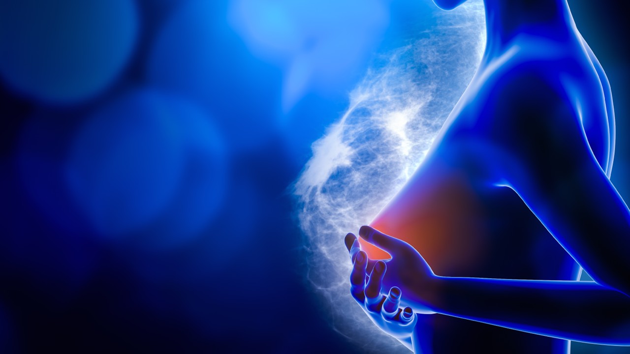 CMTNm: datopotamab deruxtecan mejora la supervivencia frente a la quimioterapia, estudio TROPION-Breast02