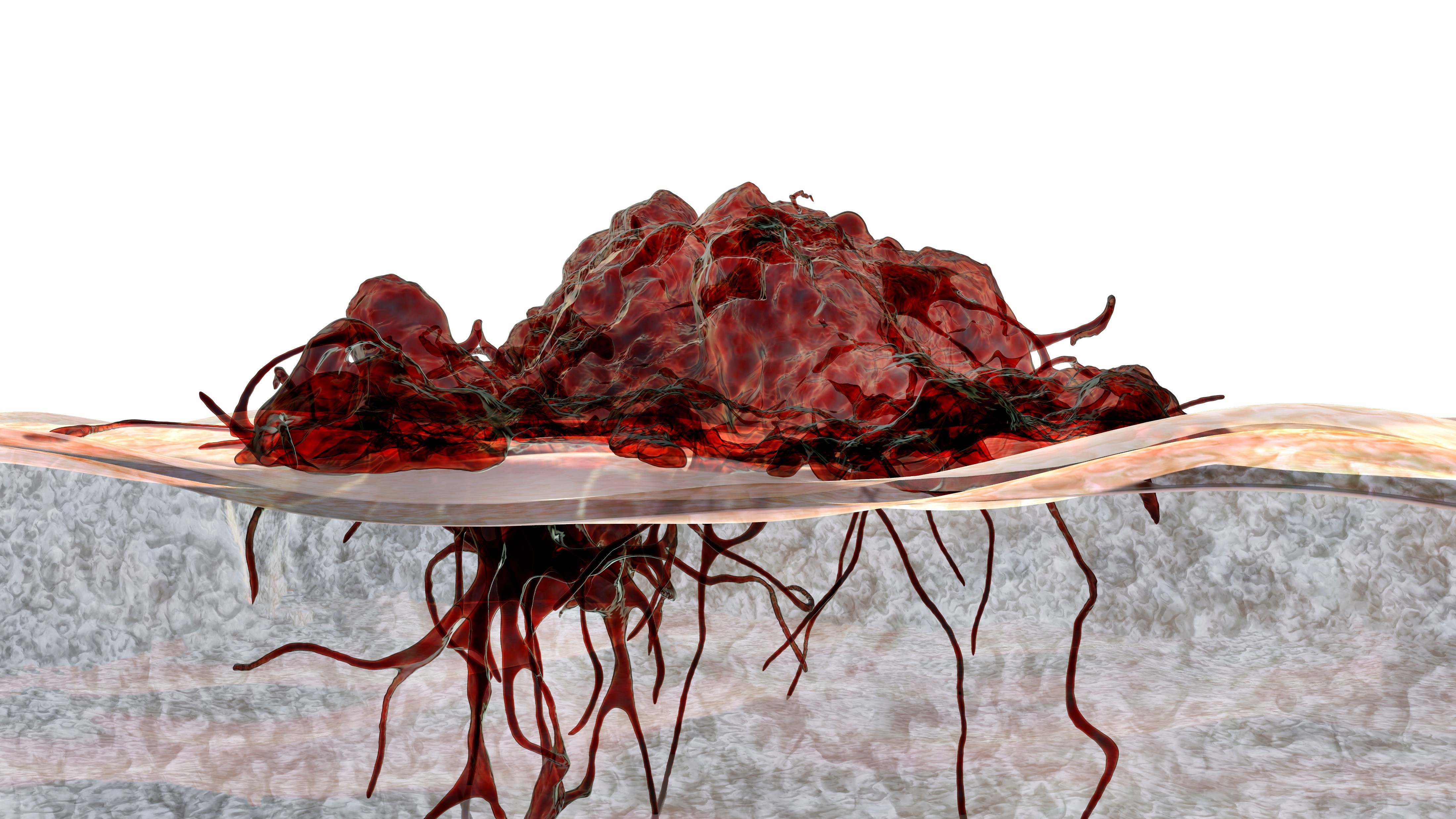 Melanoma en etapa III: daromun neoadyuvante, una inmunoterapia intralesional, mejora la SLR, estudio PIVOTAL