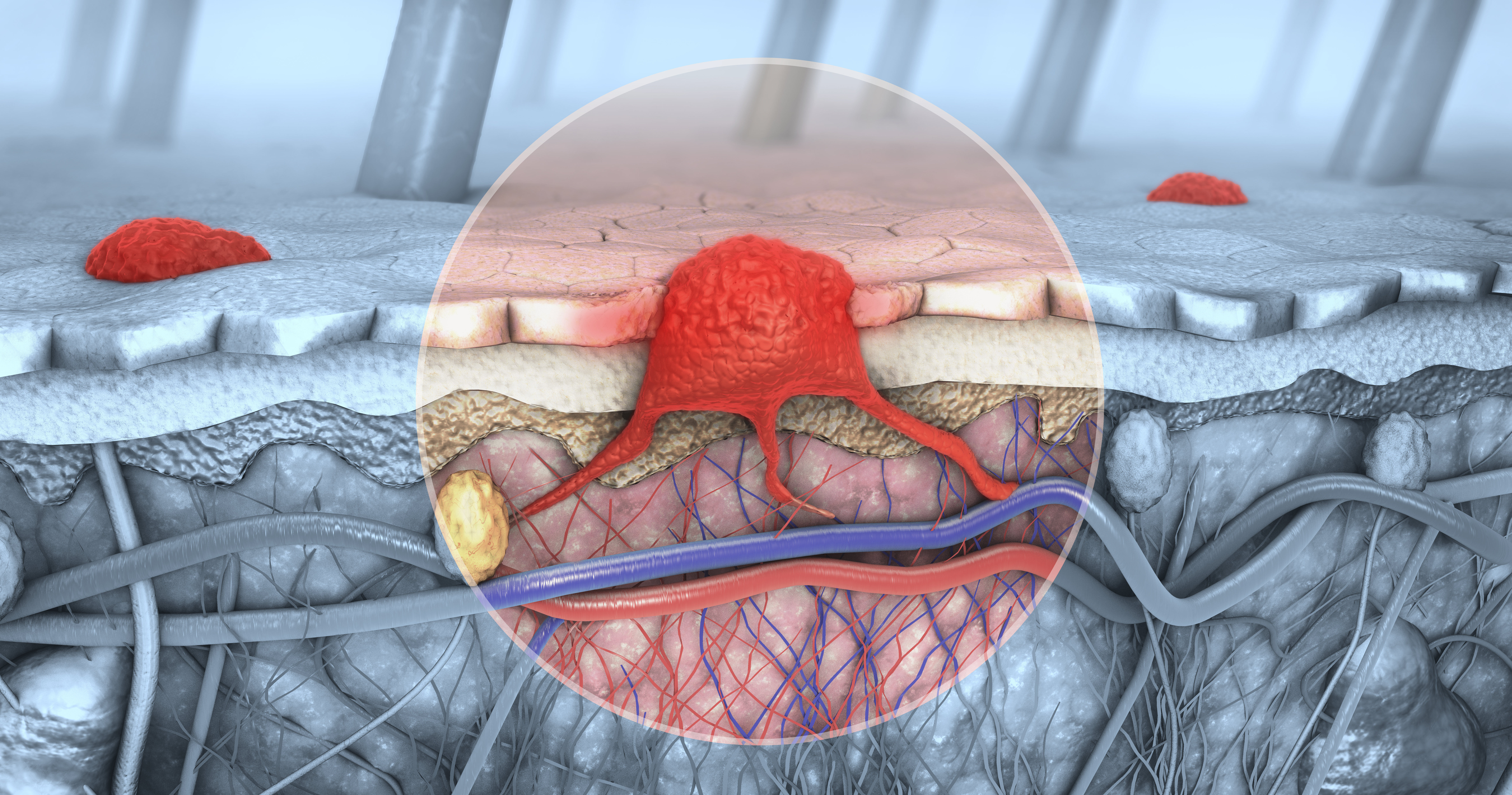 Carcinoma cutáneo de células escamosas: cemiplimab aprobado por la FDA como tratamiento adyuvante, estudio C-POST