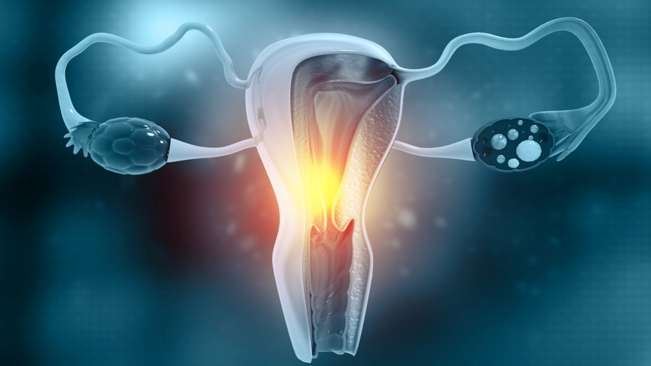 Carcinoma endometrial MSS: la FDA aprueba un diagnóstico complementario para la combinación de pembrolizumab y lenvatinib