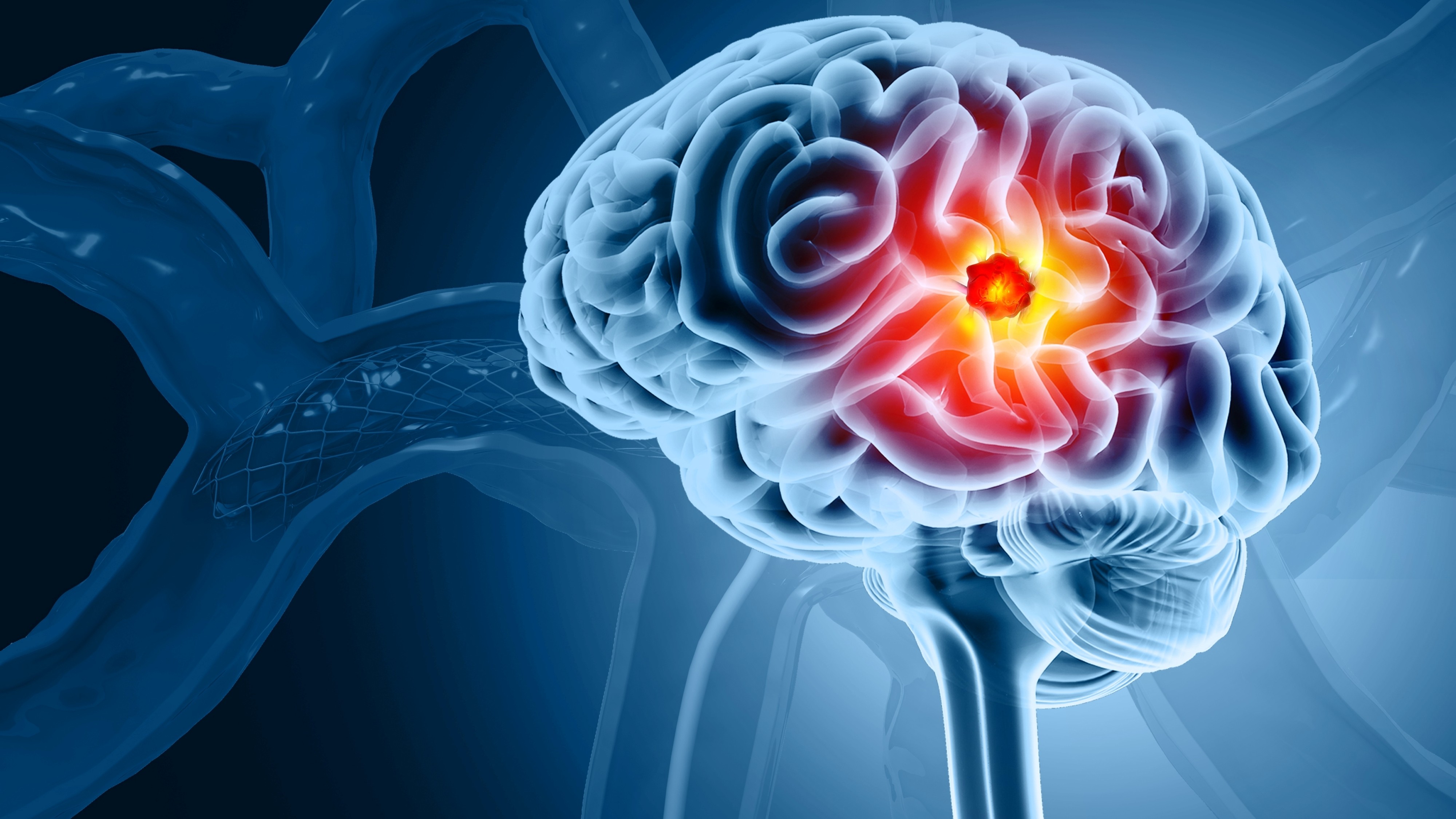 Gliomas malignos: tinostamustina recibe designación de medicamento huérfano por la FDA