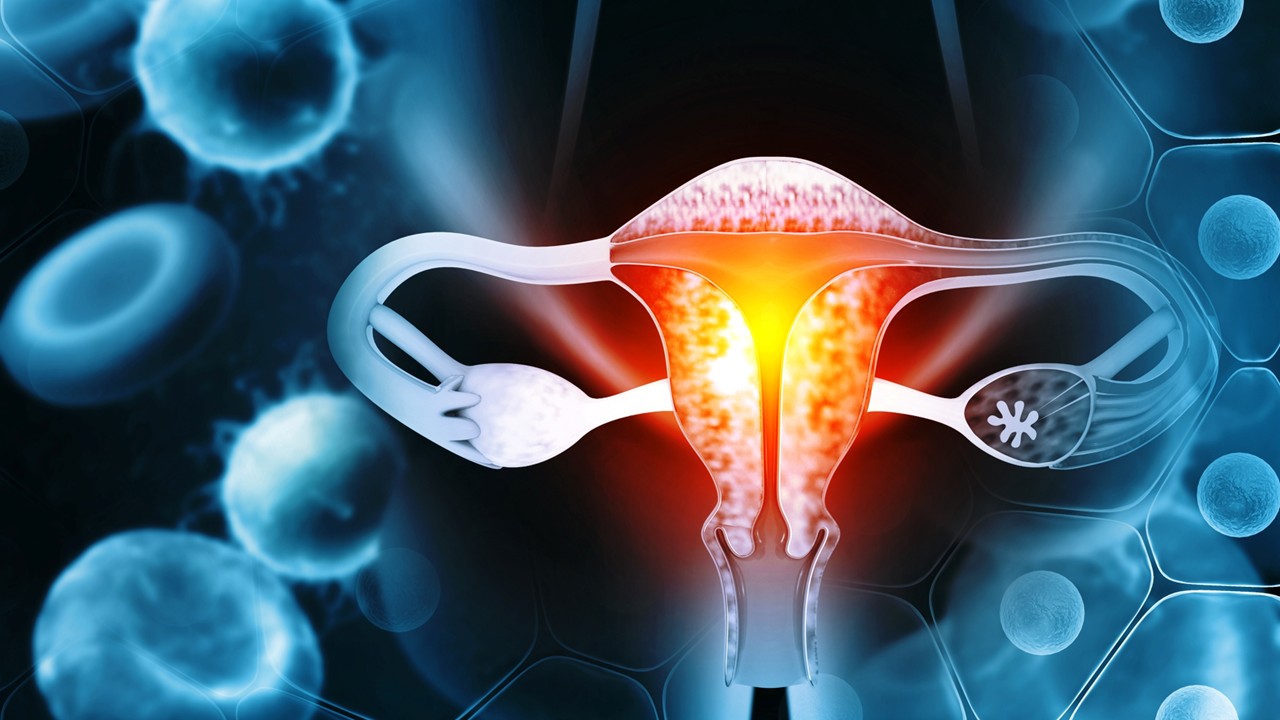 Cáncer de endometrio con estabilidad de microsatélites: la FDA autoriza el uso de OncoMate® MSI Dx como diagnóstico complementario