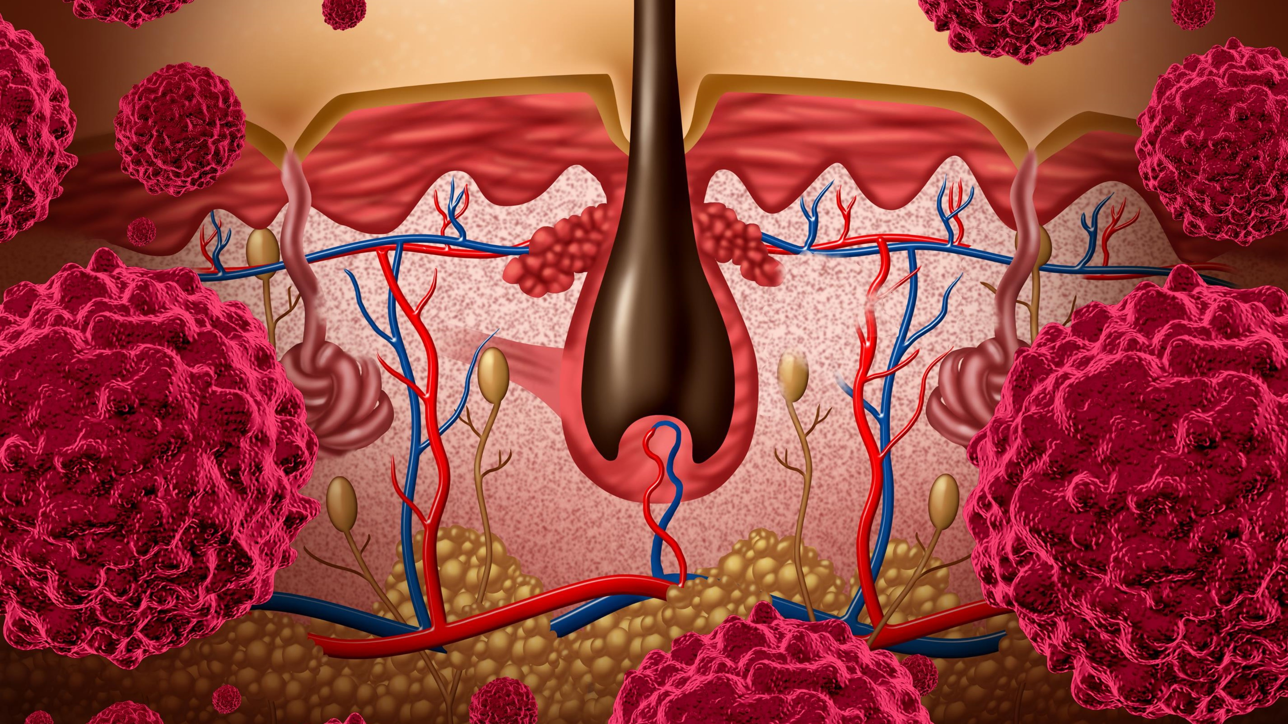 Carcinoma espinocelular cutáneo con alto riesgo de recurrencia tras cirugía y radioterapia: cemiplimab ha recibido aprobación en la UE para su uso como terapia adyuvante, estudio C-POST