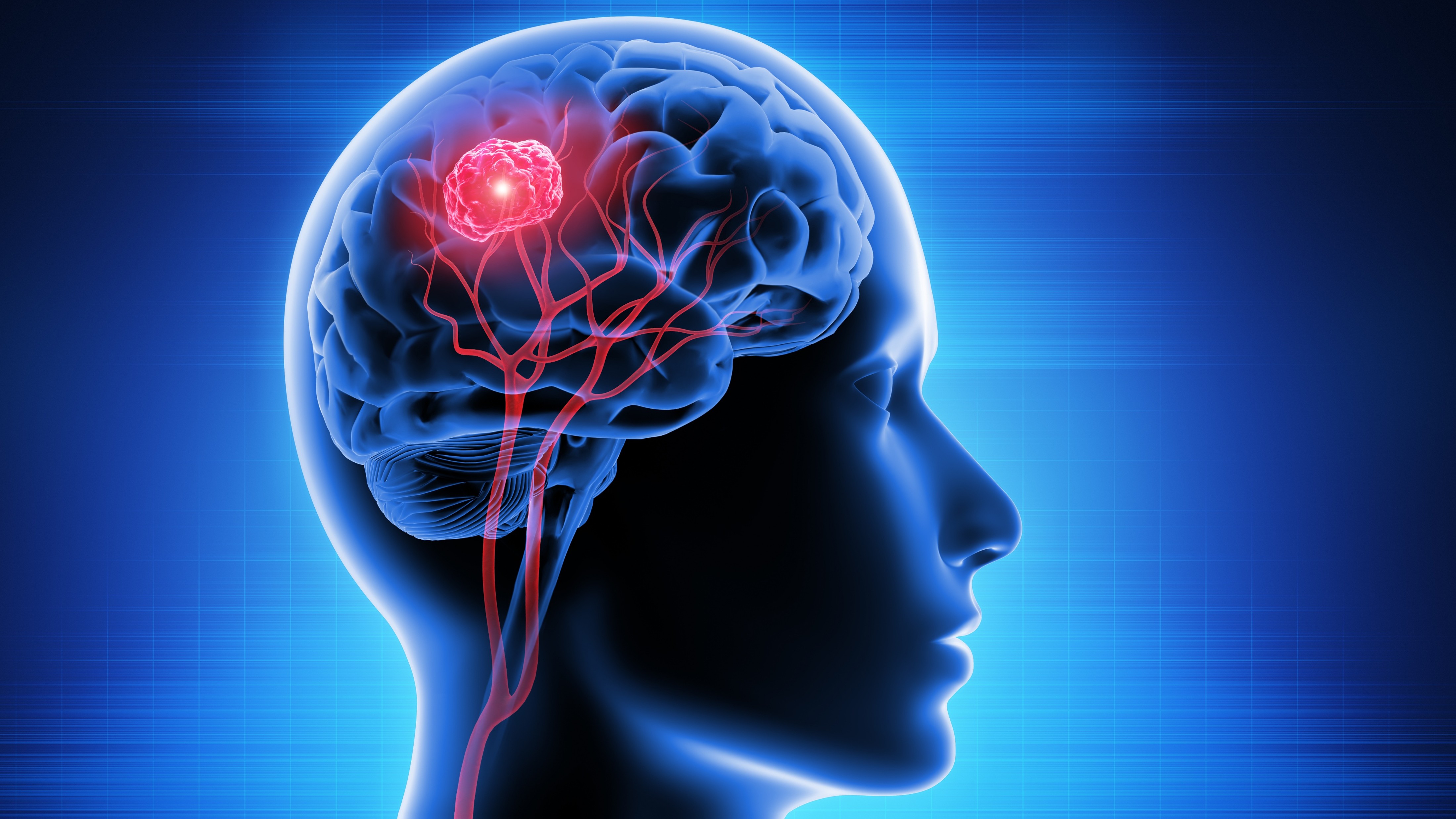 Glioma mIDH1/2: la tasa de crecimiento tumoral predice respuesta temprana y resultados con vorasidenib, estudio INDIGO