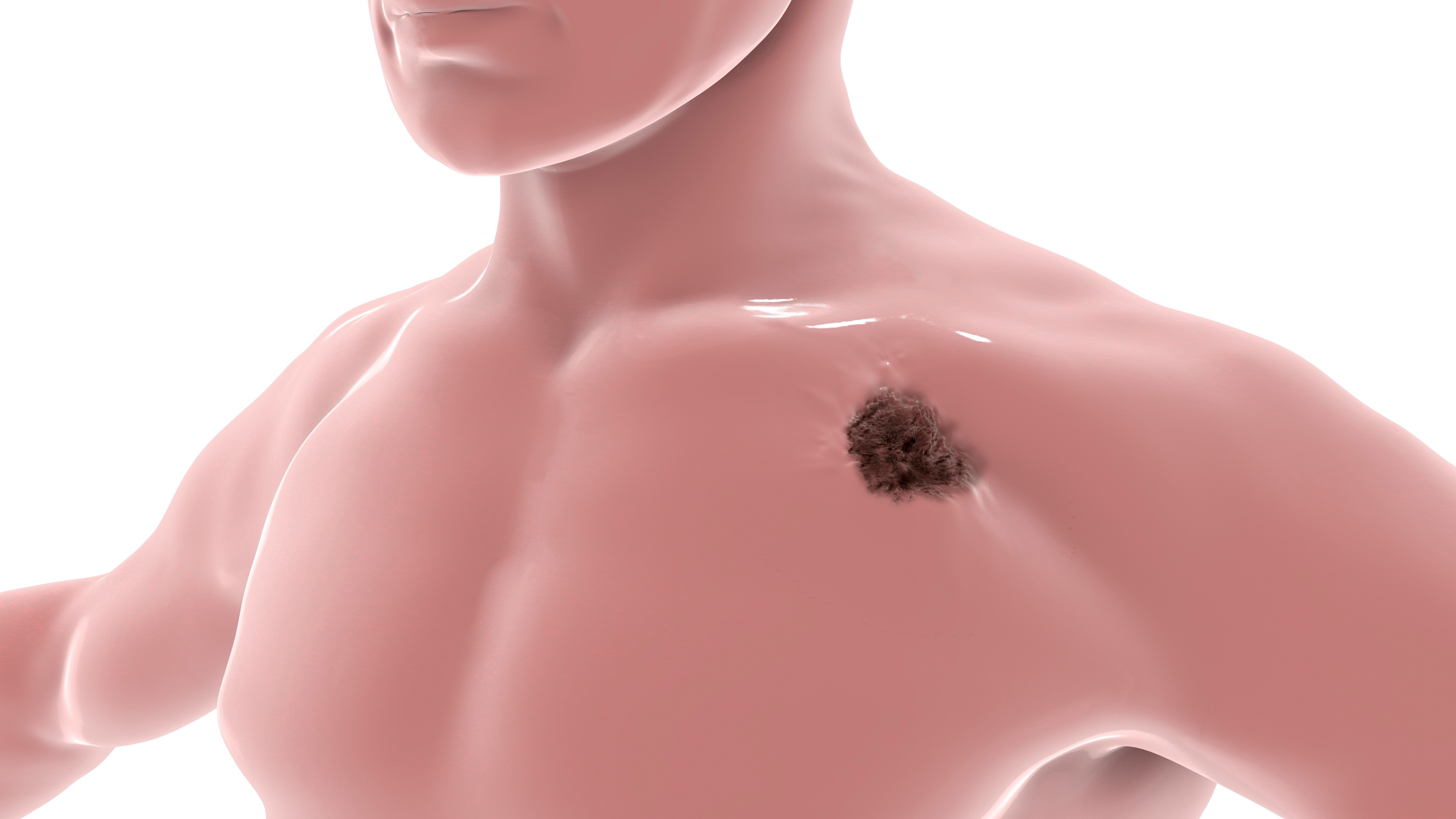 Carcinoma cutáneo de células escamosas: cosibelimab obtiene aprobación de la FDA para indicación ampliada
