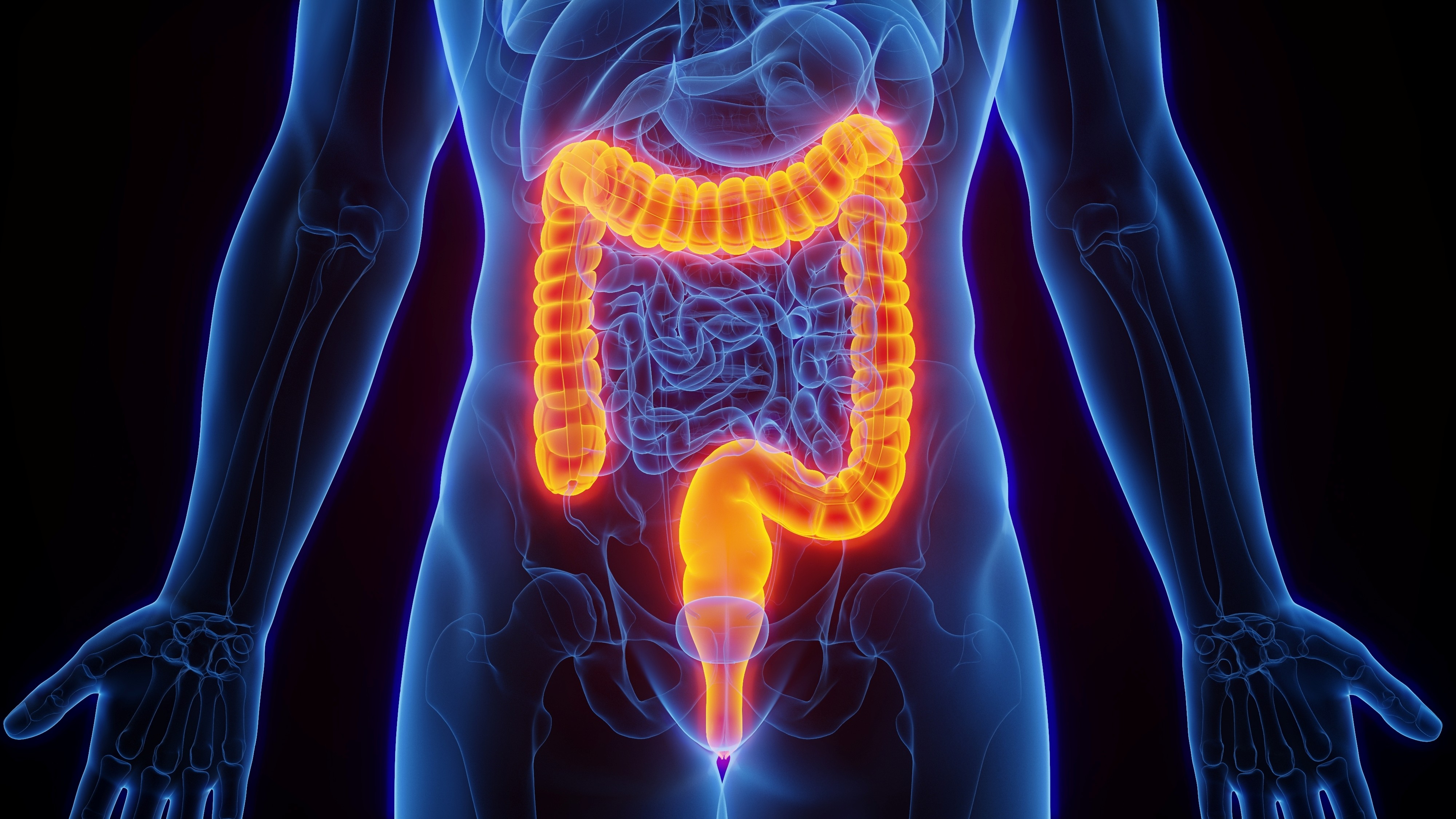 Cáncer colorrectal estadio III: Valor predictivo del ADN tumoral circulante para celecoxib adyuvante, estudio CALGB (Alliance)/SWOG 80702