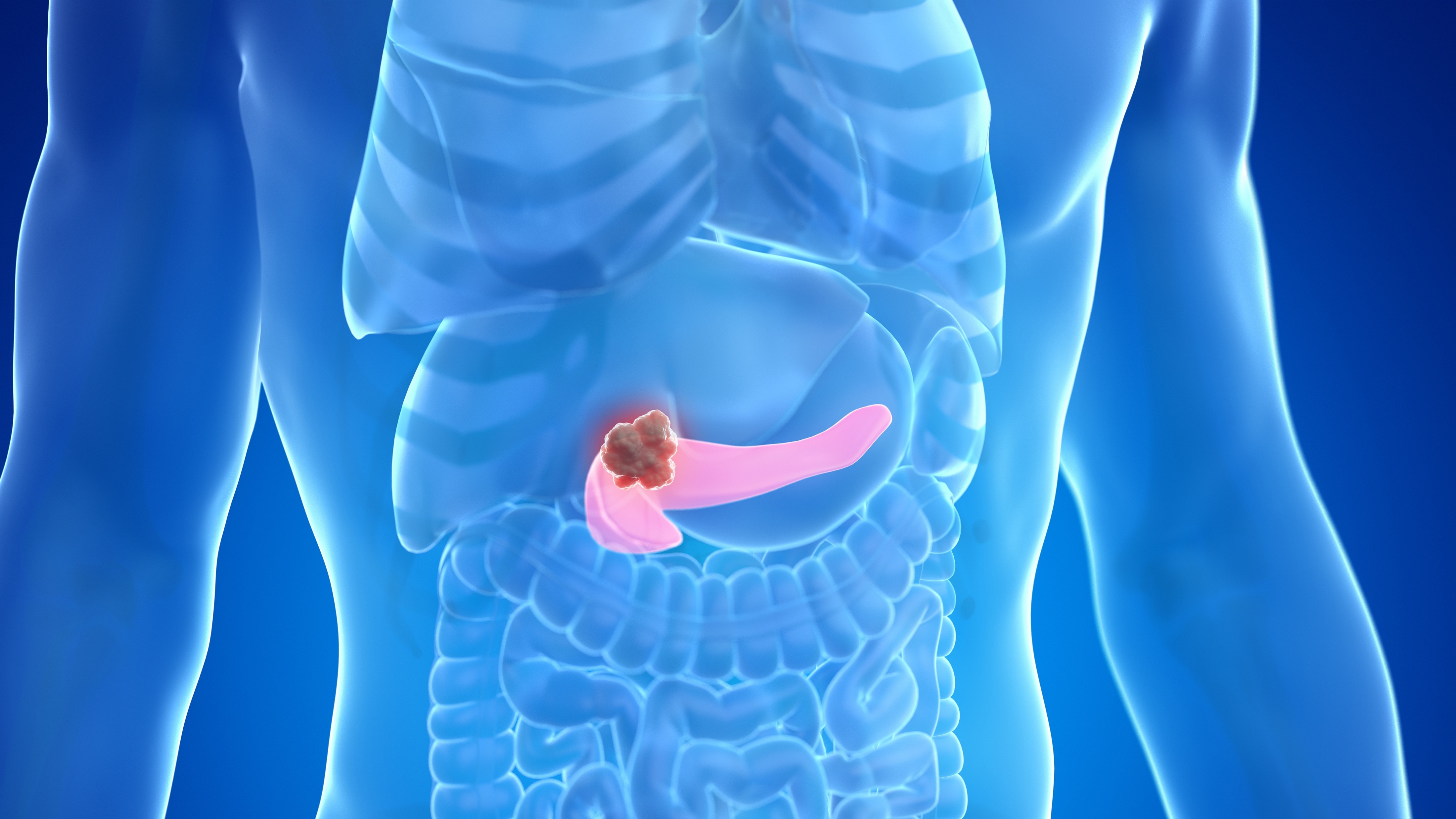 Cáncer de páncreas: designación huérfana por FDA y EMA de un agente de imagen intraoperatoria dirigido a integrinas
