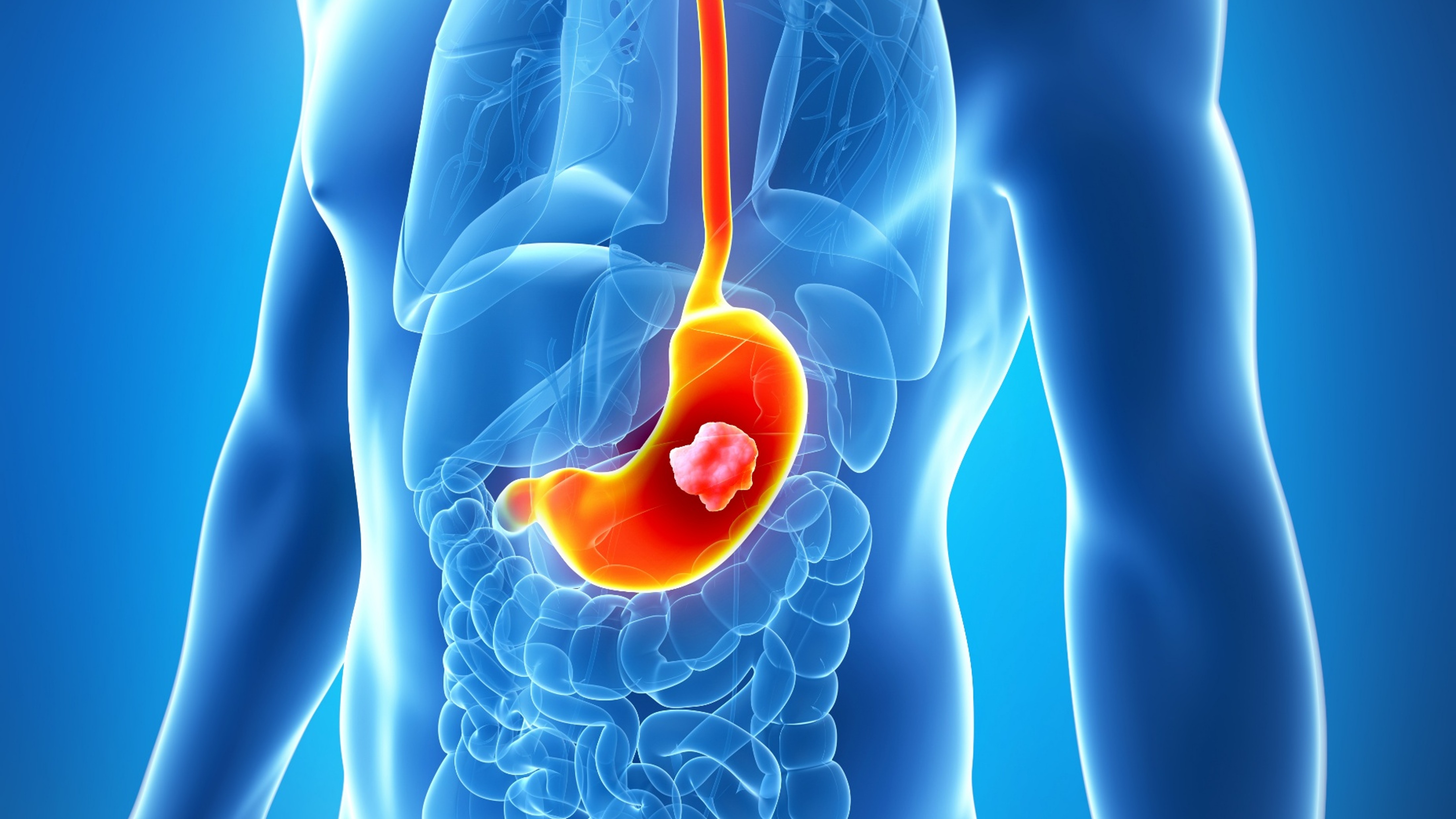 ¿Puede una inmunoterapia diseñada con IA cambiar el abordaje del cáncer gástrico? La FDA respalda a HCB101 con designación huérfana