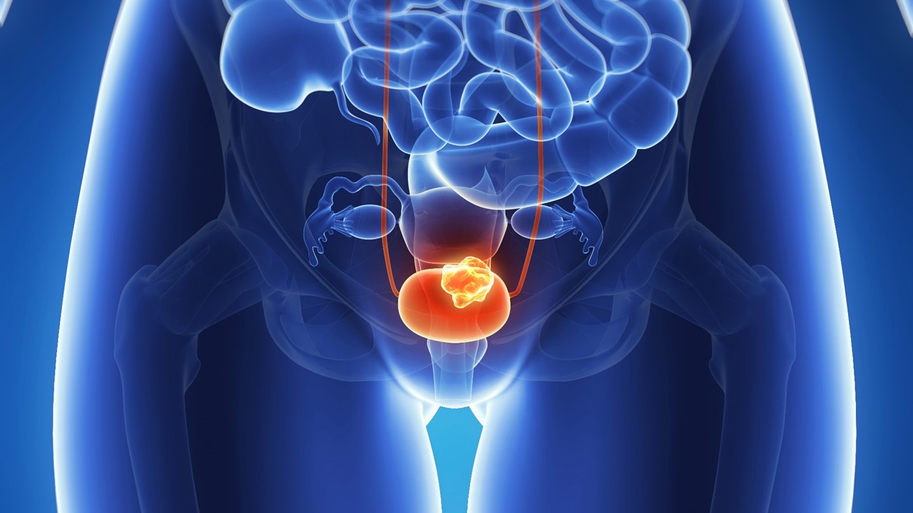 Enfortumab vedotin más pembrolizumab perioperatorios mejoran SLE y SG vs. cirugía sola en cáncer vesical músculo-invasivo inelegible para cisplatino: KEYNOTE-905/EV-303