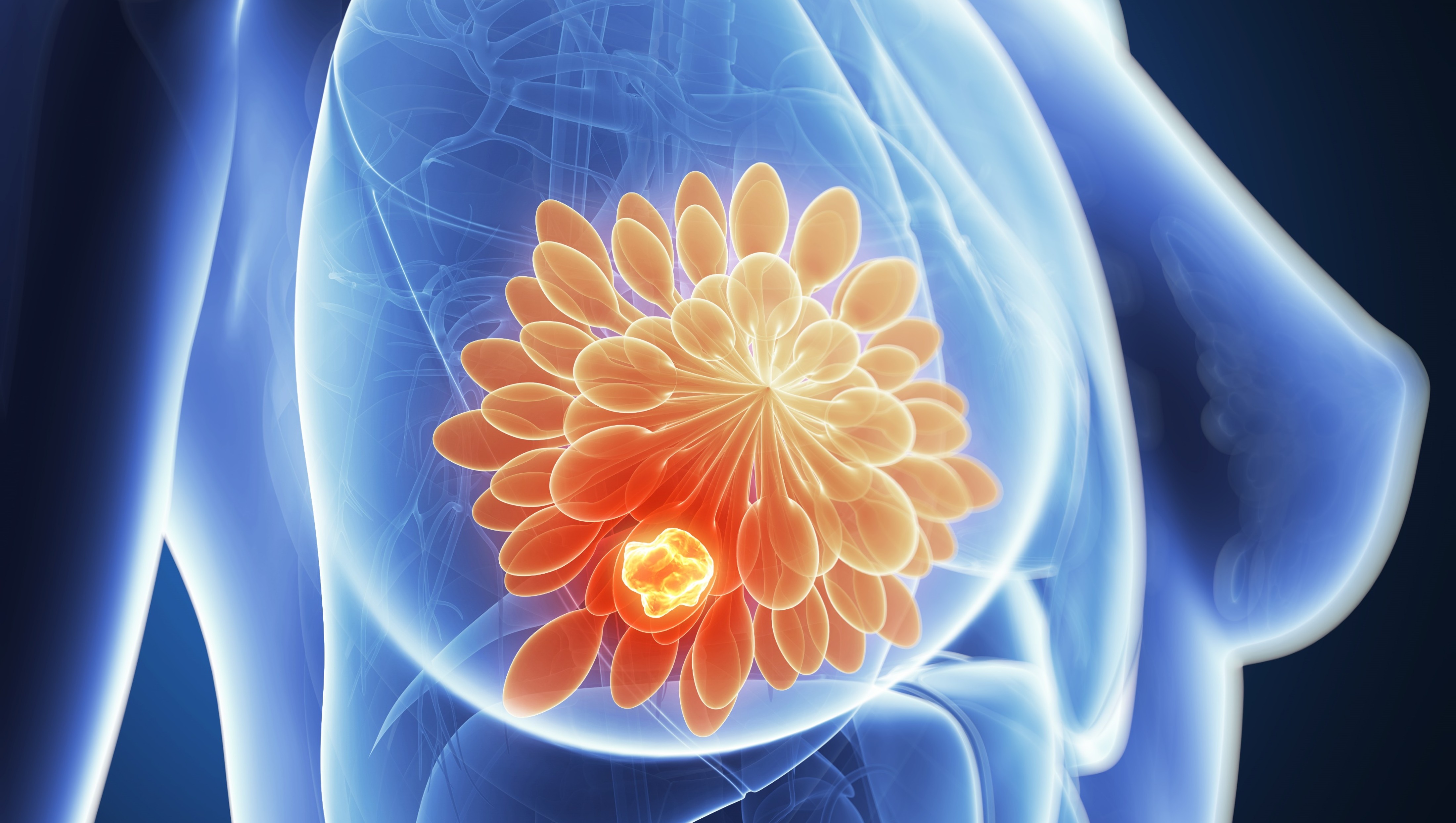 ¿Menos tiempo, mismos resultados? Radioterapia de 3 semanas supera la prueba en cáncer de mama, estudio HypoG-01