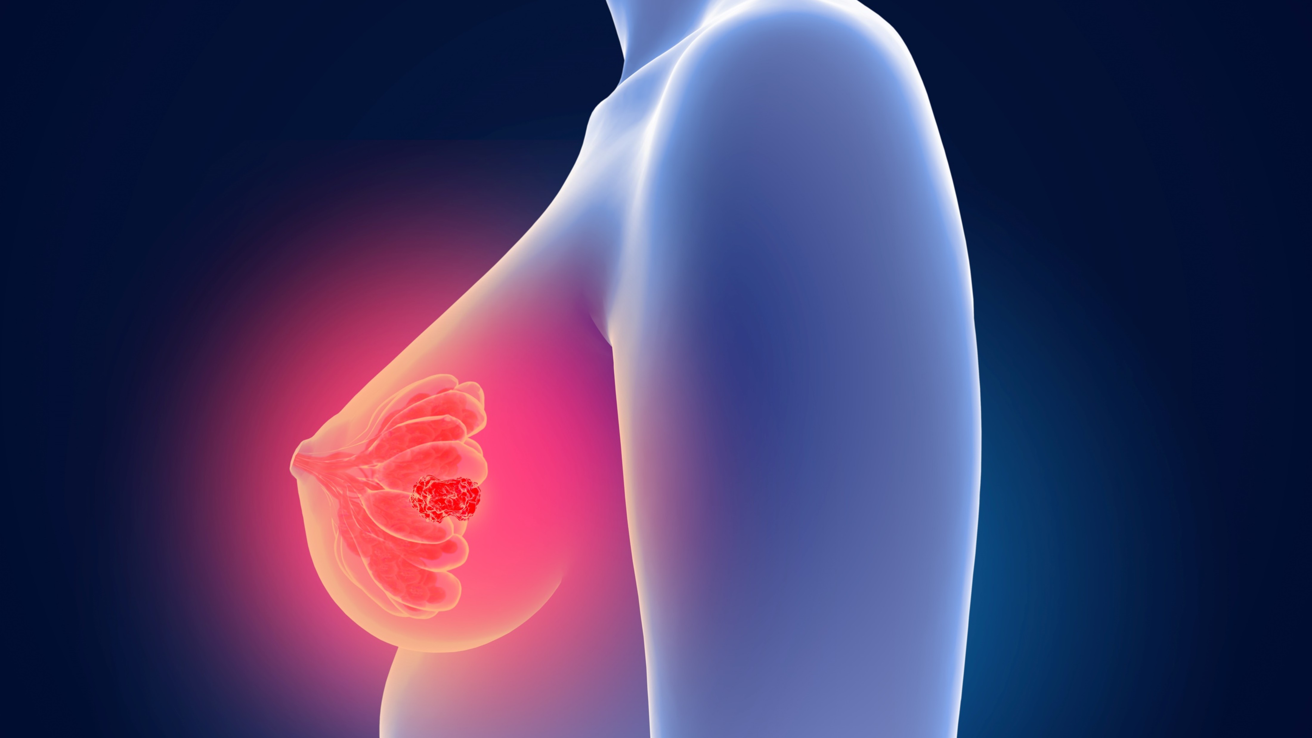 ¿Qué pacientes tienen mayor beneficio de agregar pertuzumab a la adyuvancia en cáncer de mama HER2-positivo?
