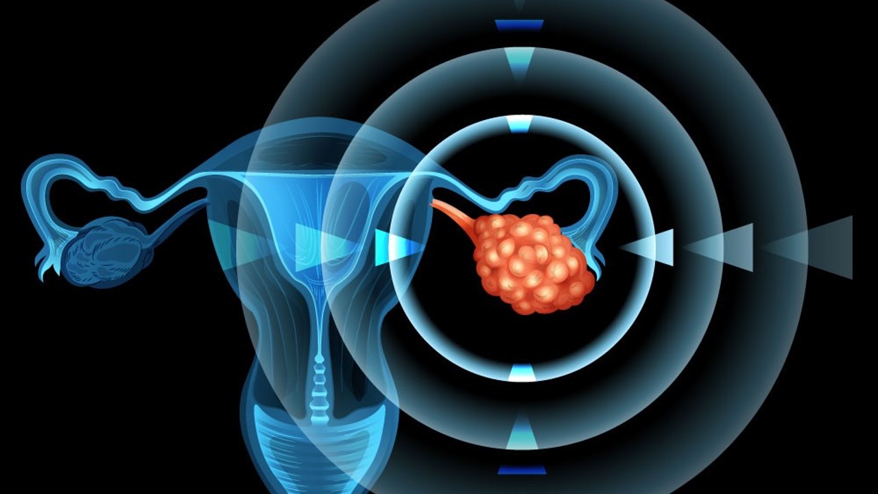 Pembrolizumab y paclitaxel semanal en cáncer de ovario resistente a platino: resultados del ENGOT-ov65/KEYNOTE-B96