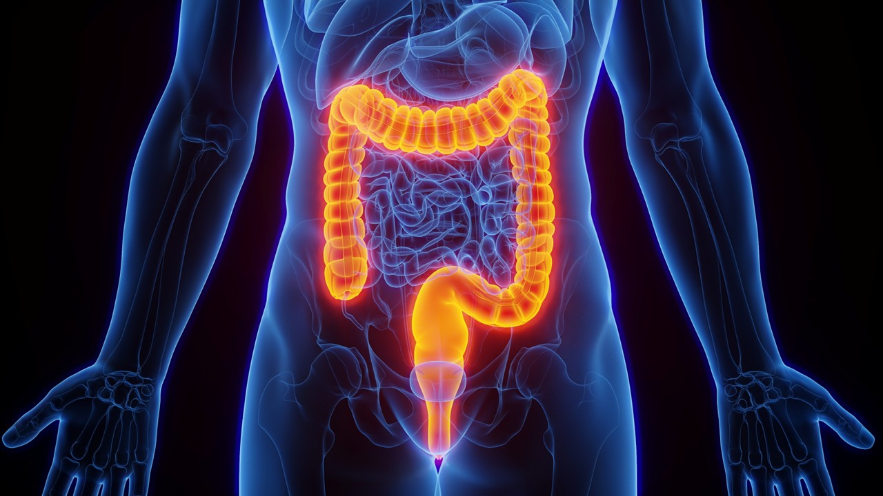Integración del ctDNA y los factores patológicos para la estratificación del riesgo de recurrencia en cáncer de colon: resultados del estudio PROVENC3