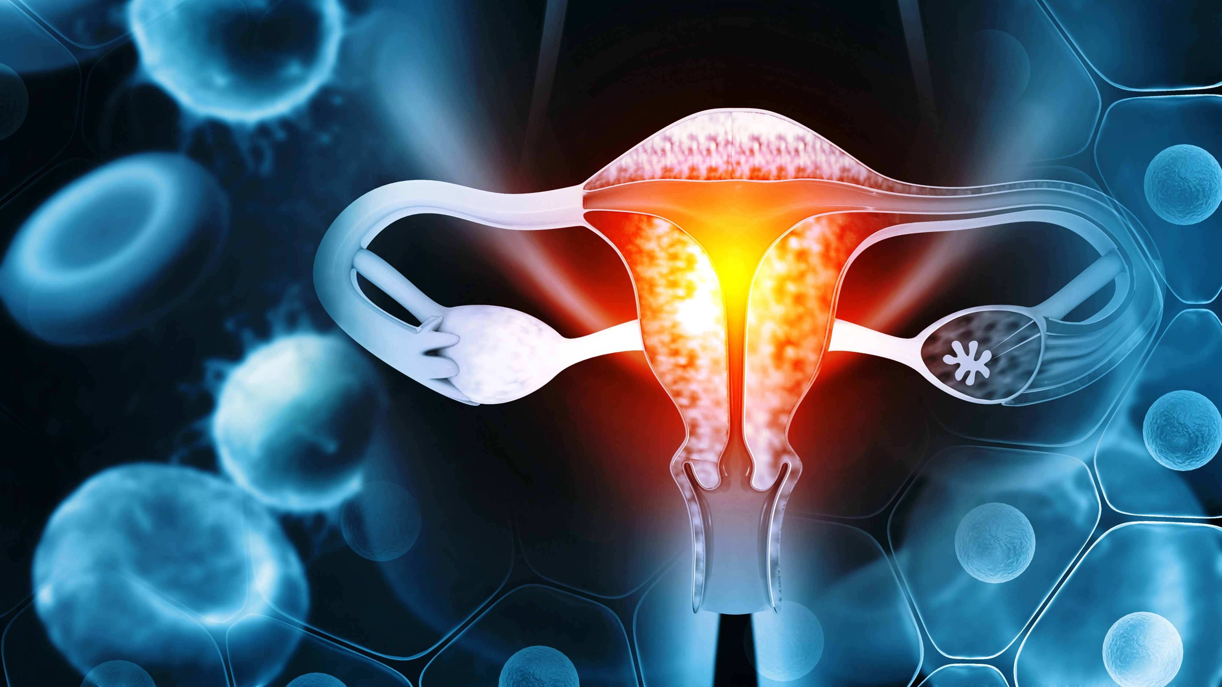 TroFuse-005: Sacituzumab tirumotecan logra beneficio en SG y SLP en pacientes con cáncer de endometrio previamente tratadas