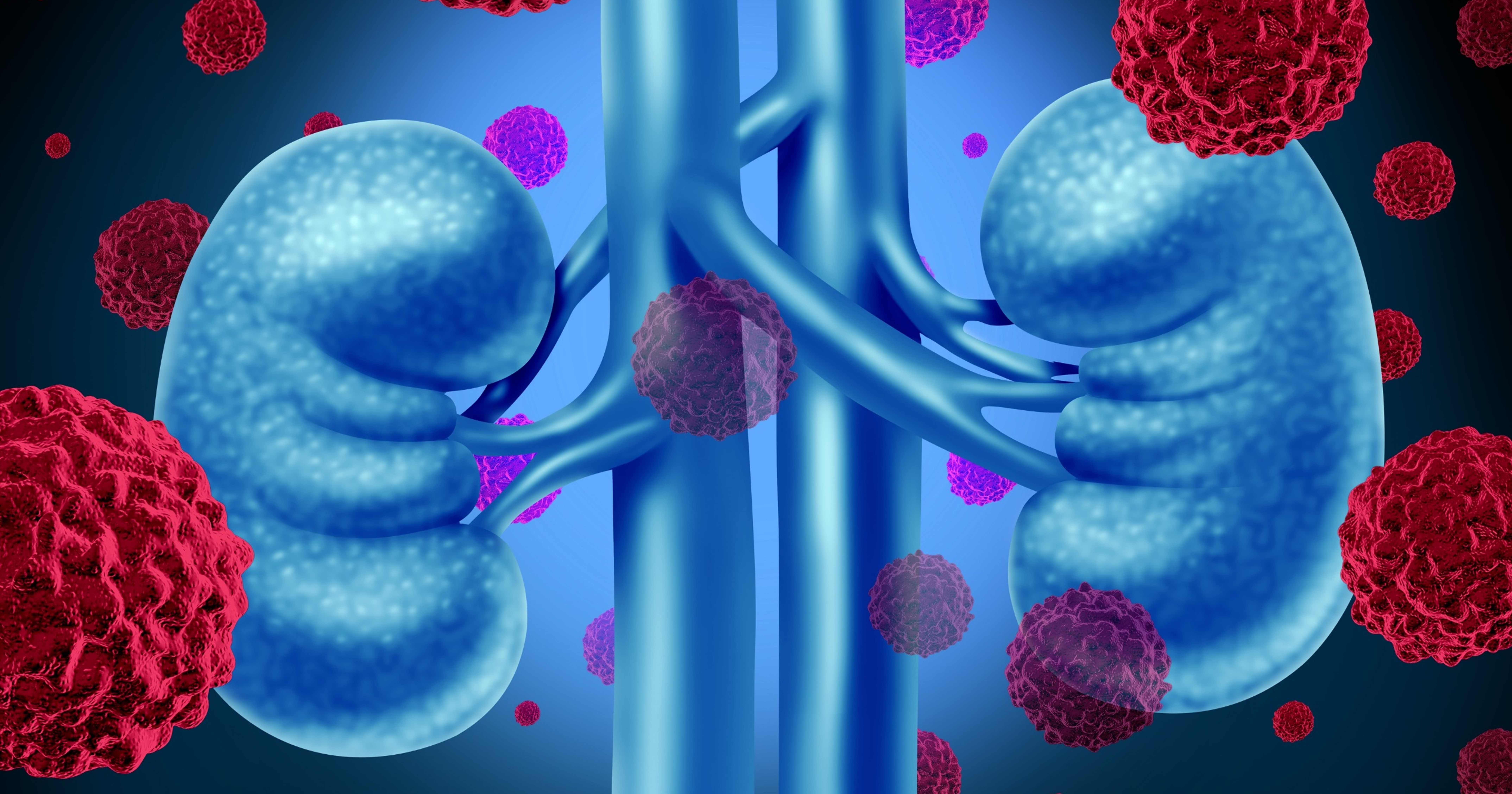 TROG 15.03 FASTRACK II: Radioterapia ablativa estereotáctica en carcinoma de células renales inoperable