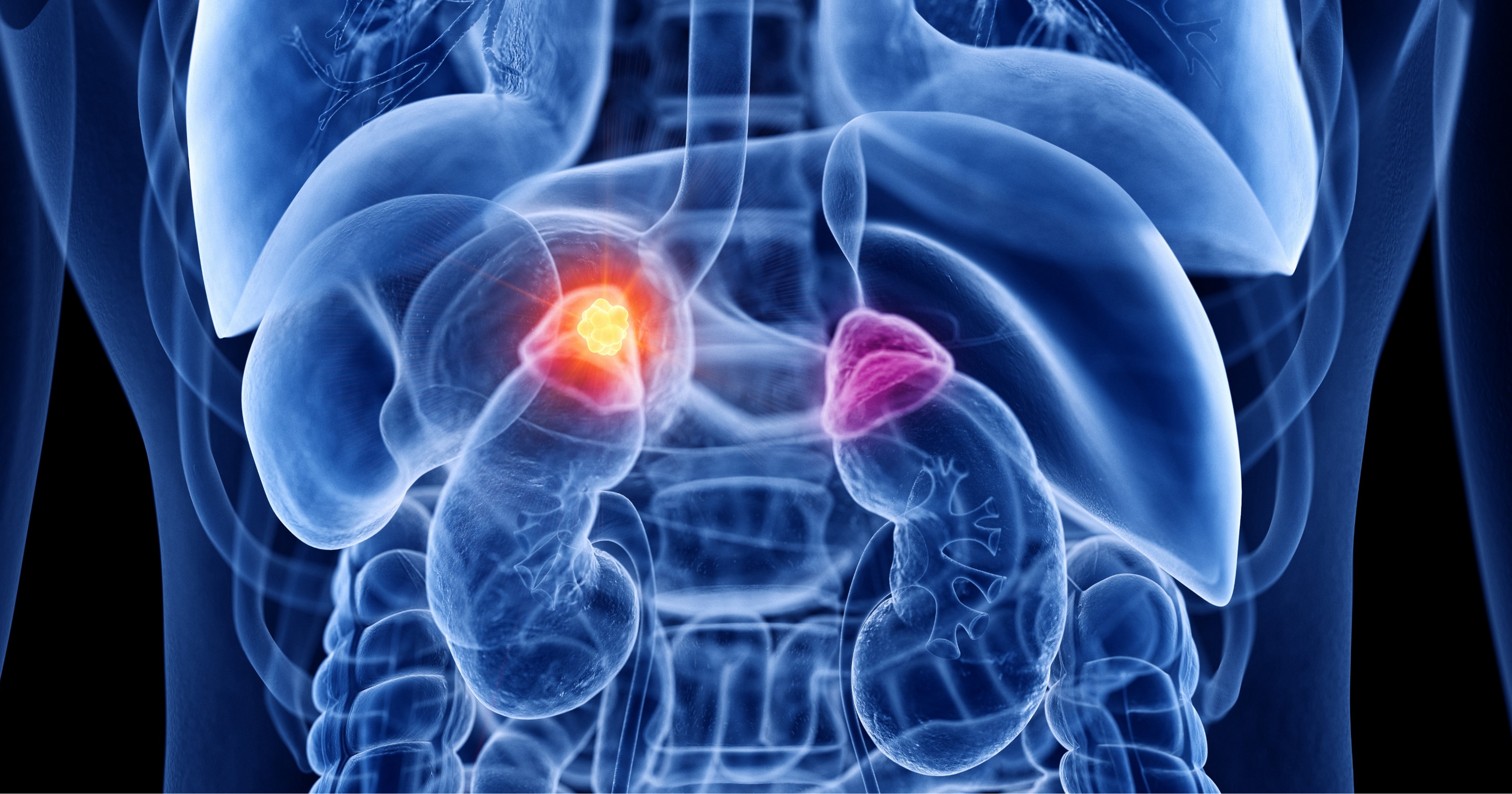 La FDA aprueba belzutifan más pembrolizumab en el tratamiento adyuvante del carcinoma renal de células claras