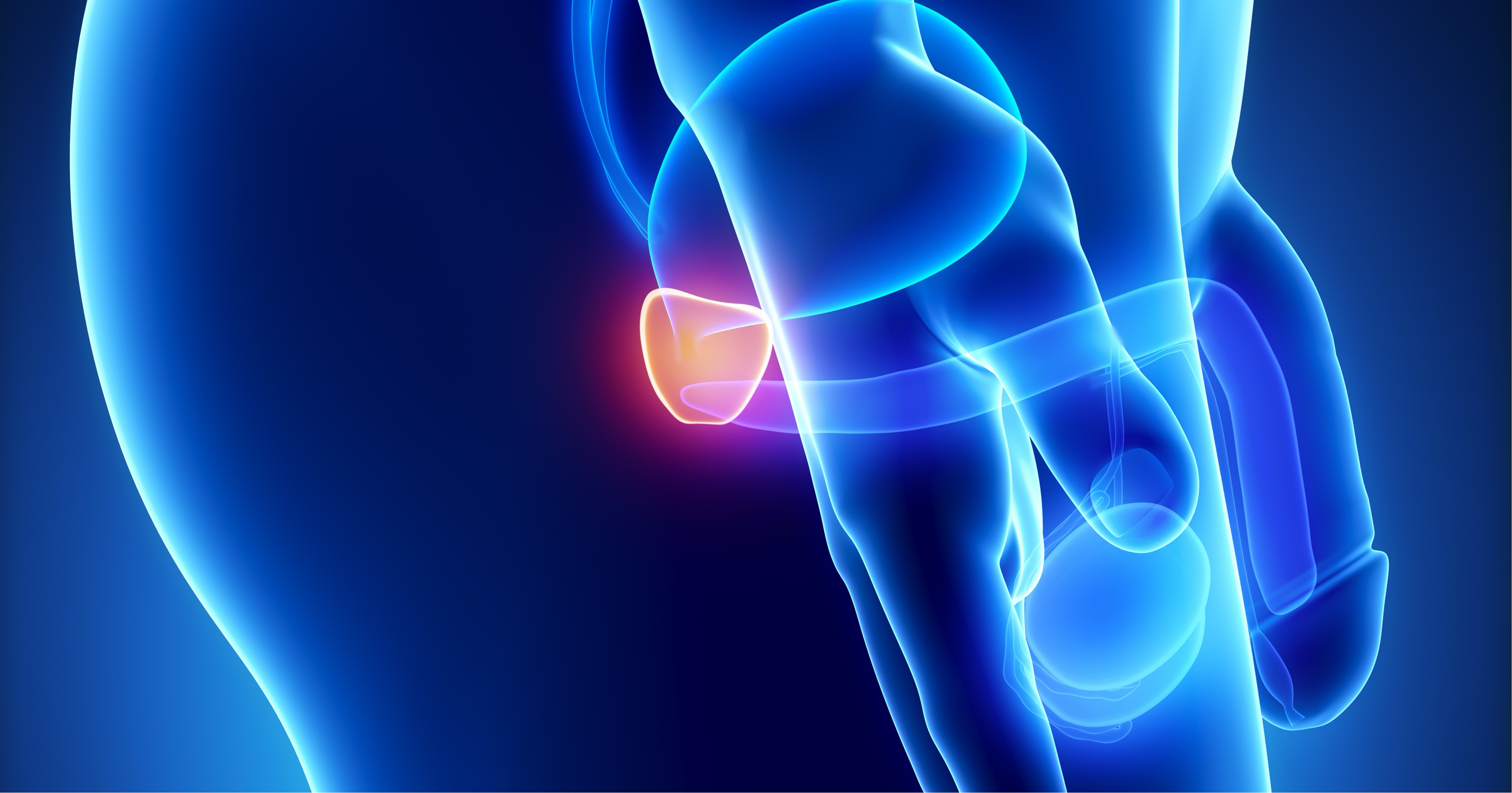 La FDA aprueba capivasertib más abiraterona en cáncer de próstata metastásico hormonosensible con deficiencia de PTEN