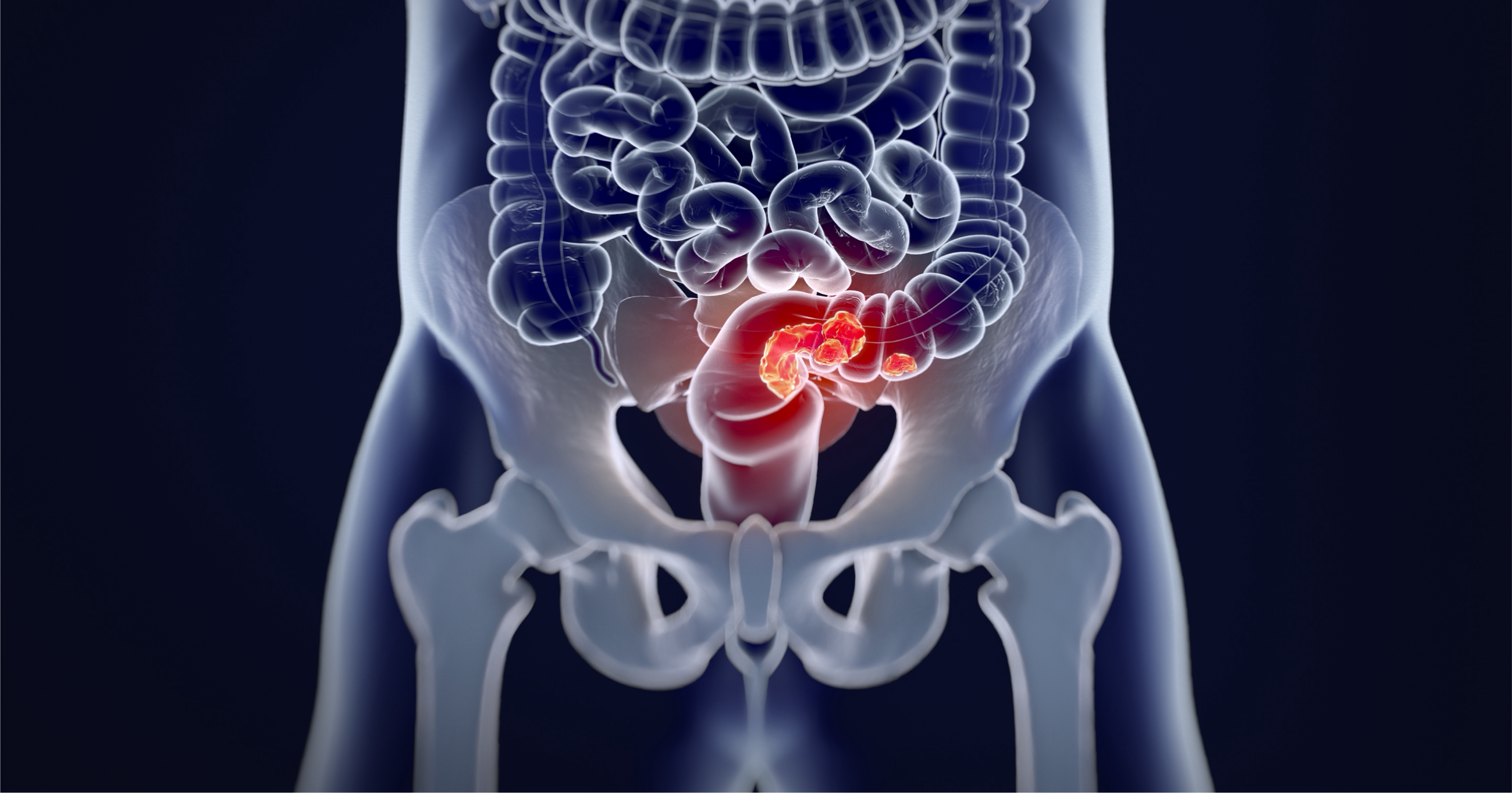 Resultados de supervivencia del estudio STELLAR-303 en pacientes con cáncer colorrectal metastásico sin lesiones hepáticas
