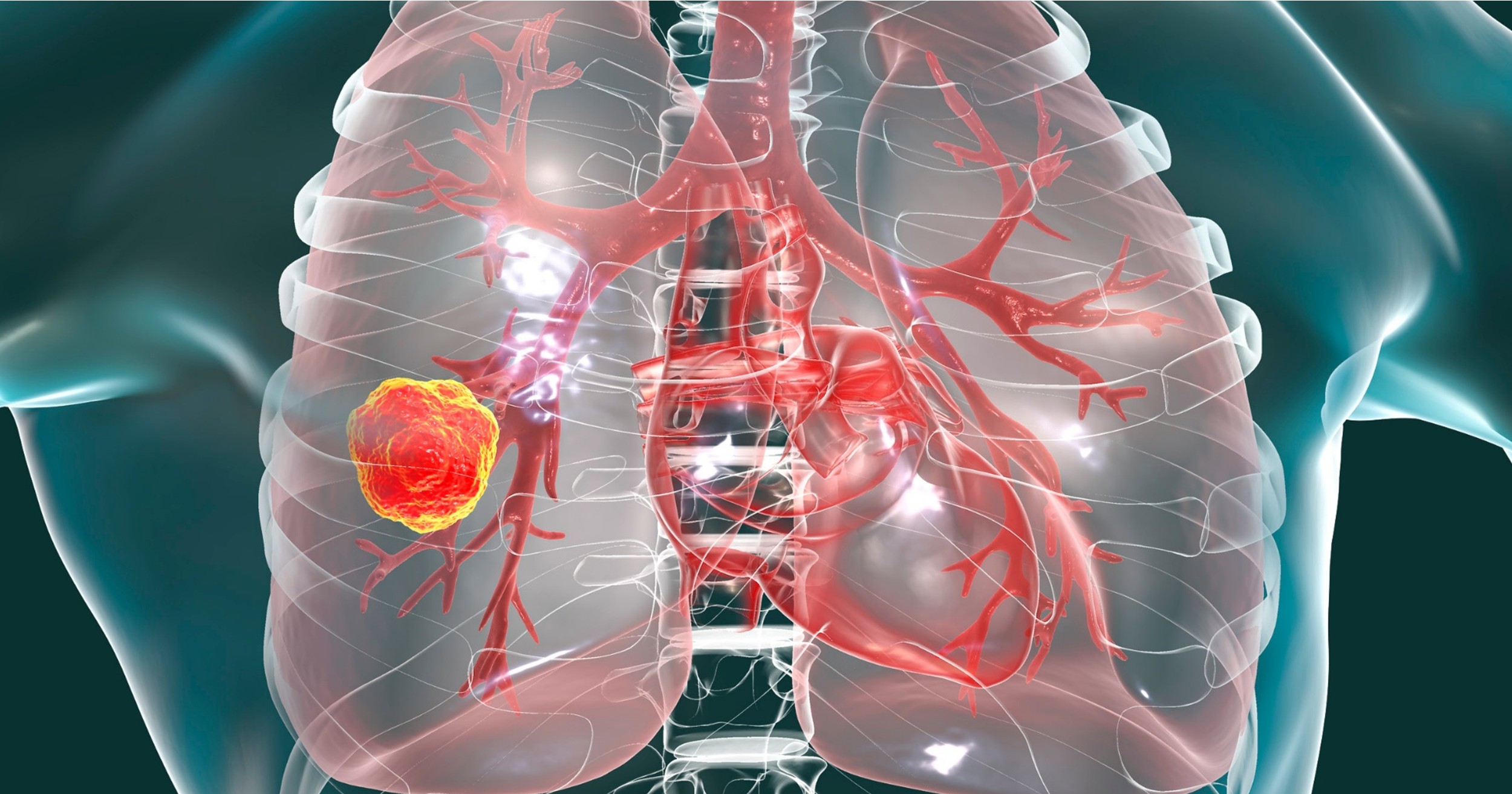 T-DXd en pacientes con CPCNP HER2m en el mundo real: Evidencia de la cohorte TRACER/HERTras