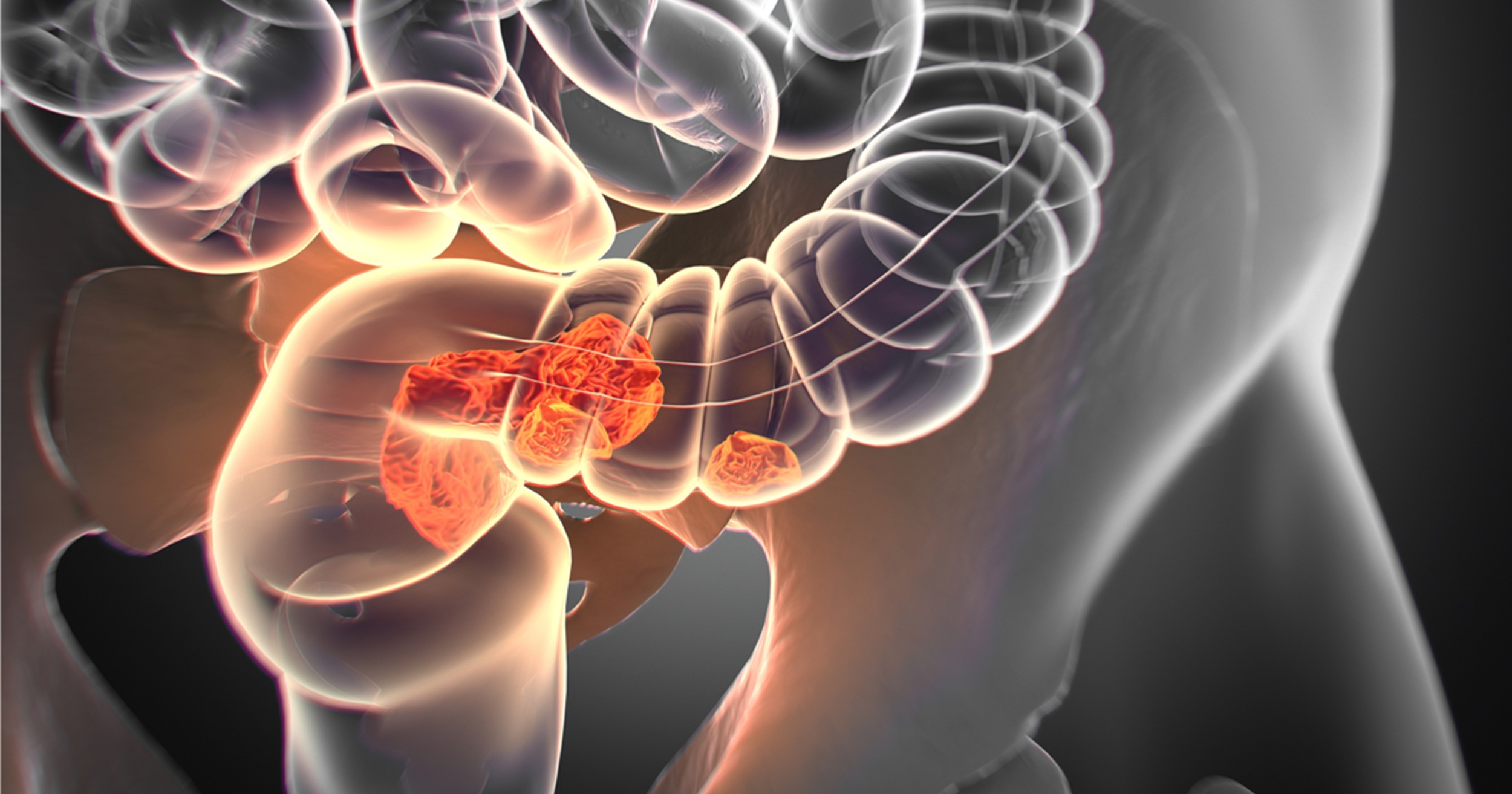 TNT con doblete de QT y RT de curso largo mejora la SLE en pacientes con cáncer de recto localmente avanzado de alto riesgo