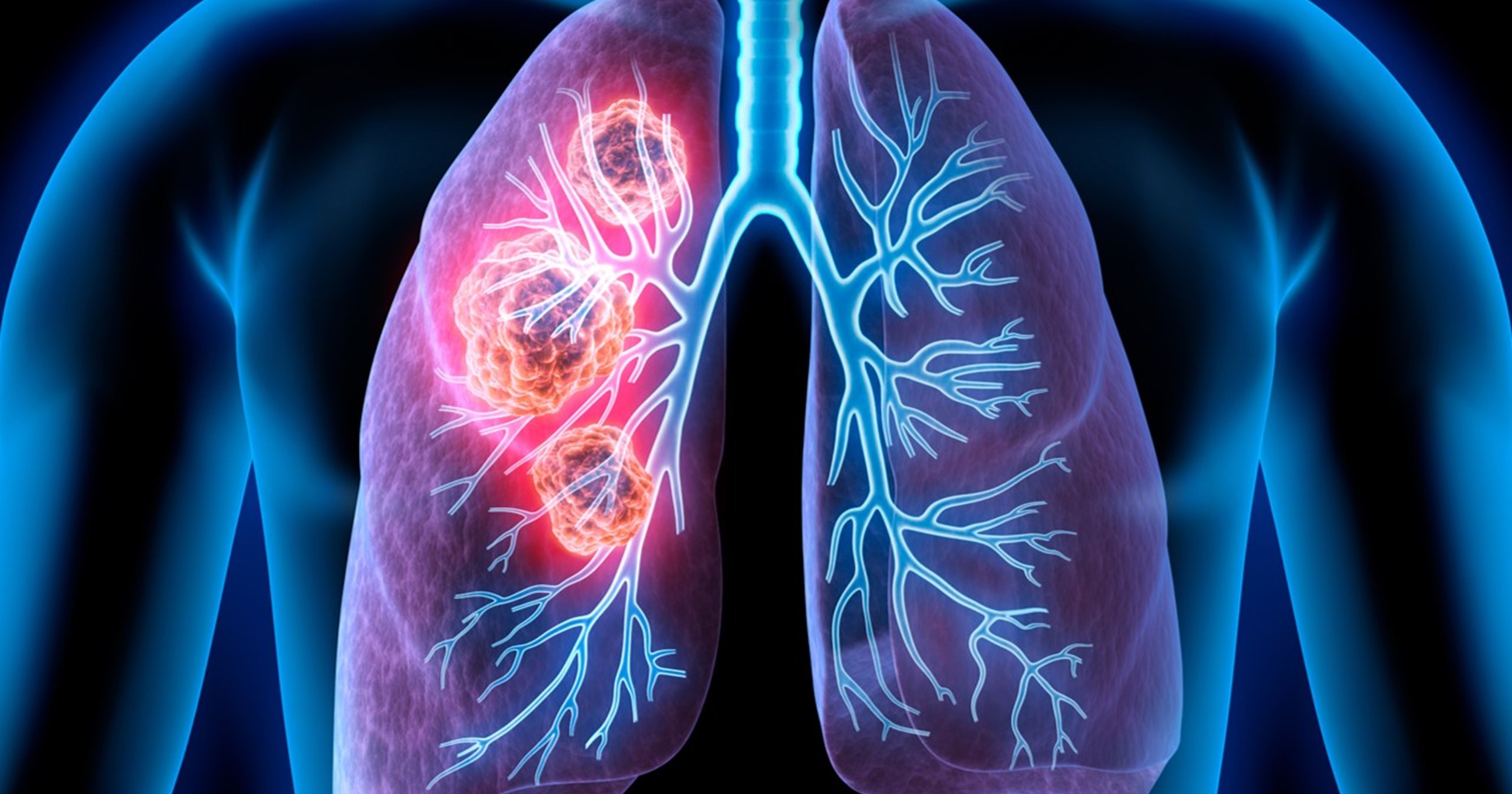 Impacto de los IBP y antibióticos en la eficacia de durvalumab tras quimiorradioterapia en el estudio PACIFIC
