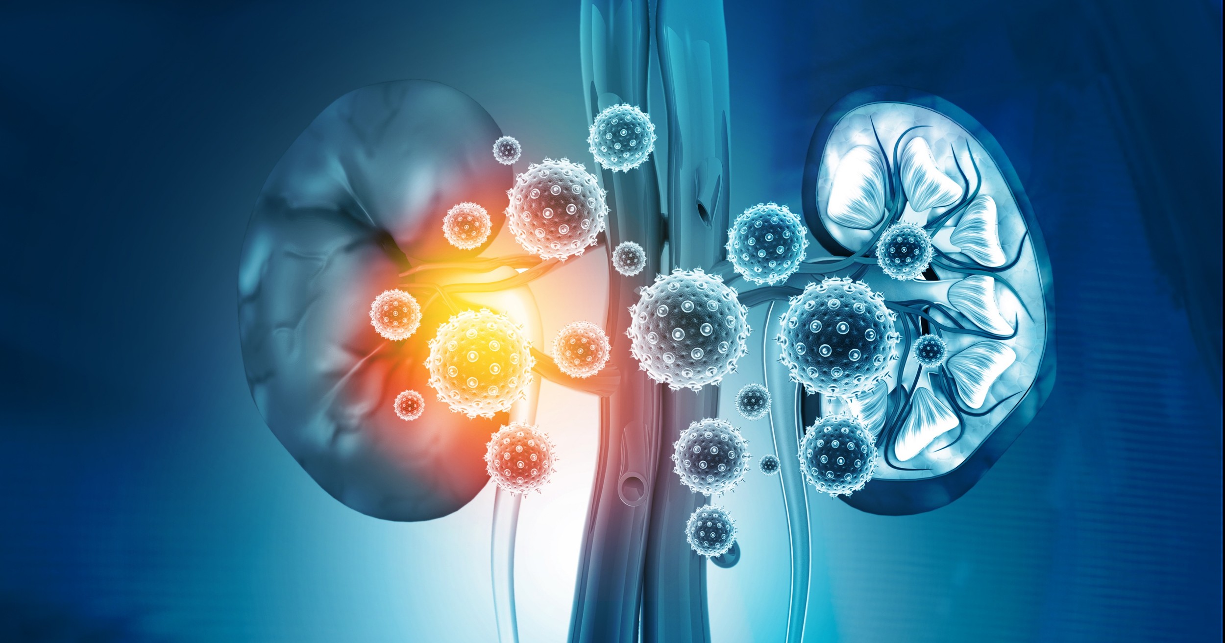 Eficacia de pirarubicina intravesical en la recurrencia tras la nefroureterectomía por carcinoma urotelial del tracto superior