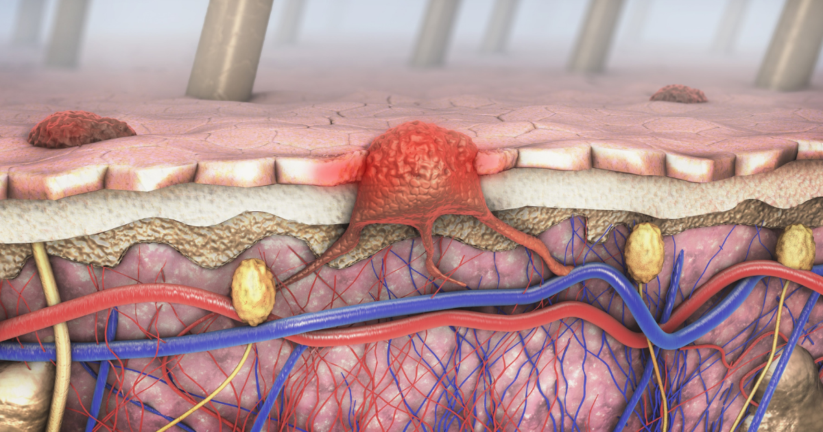Eficacia de la terapia de neoantígenos individualizada más pembrolizumab en pacientes con melanoma resecado etapas IIB-IV